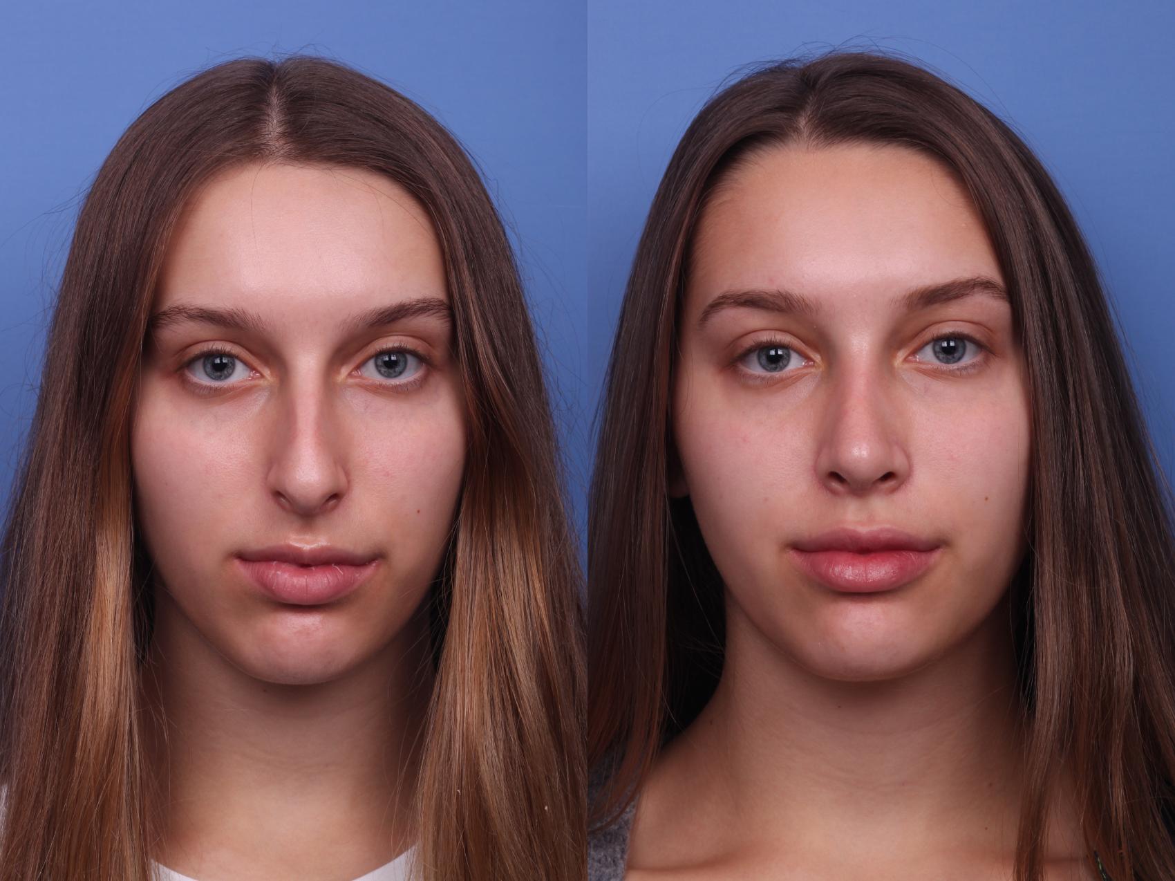 Before & After Rhinoplasty Case 356 Front View in Scottsdale, AZ