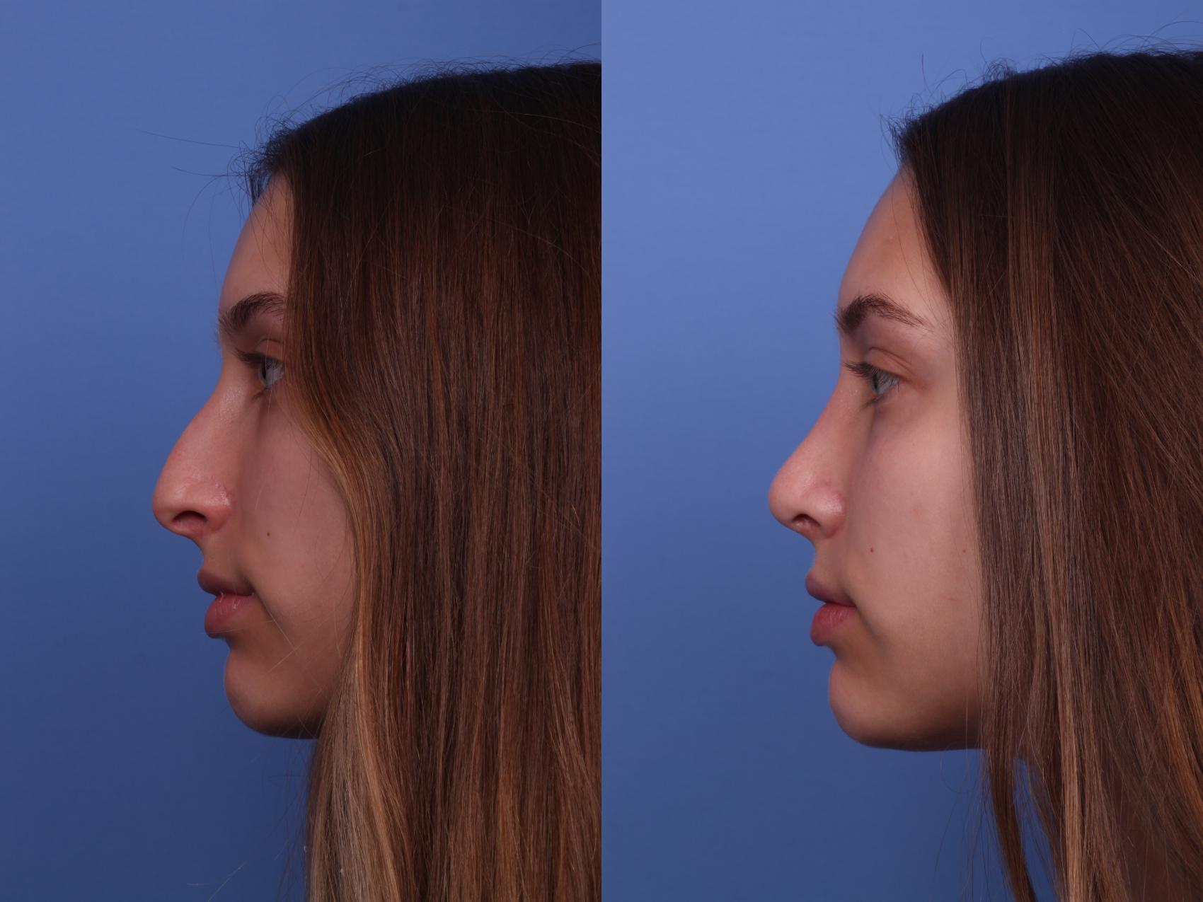 Before & After Rhinoplasty Case 356 Left Side View in Scottsdale, AZ