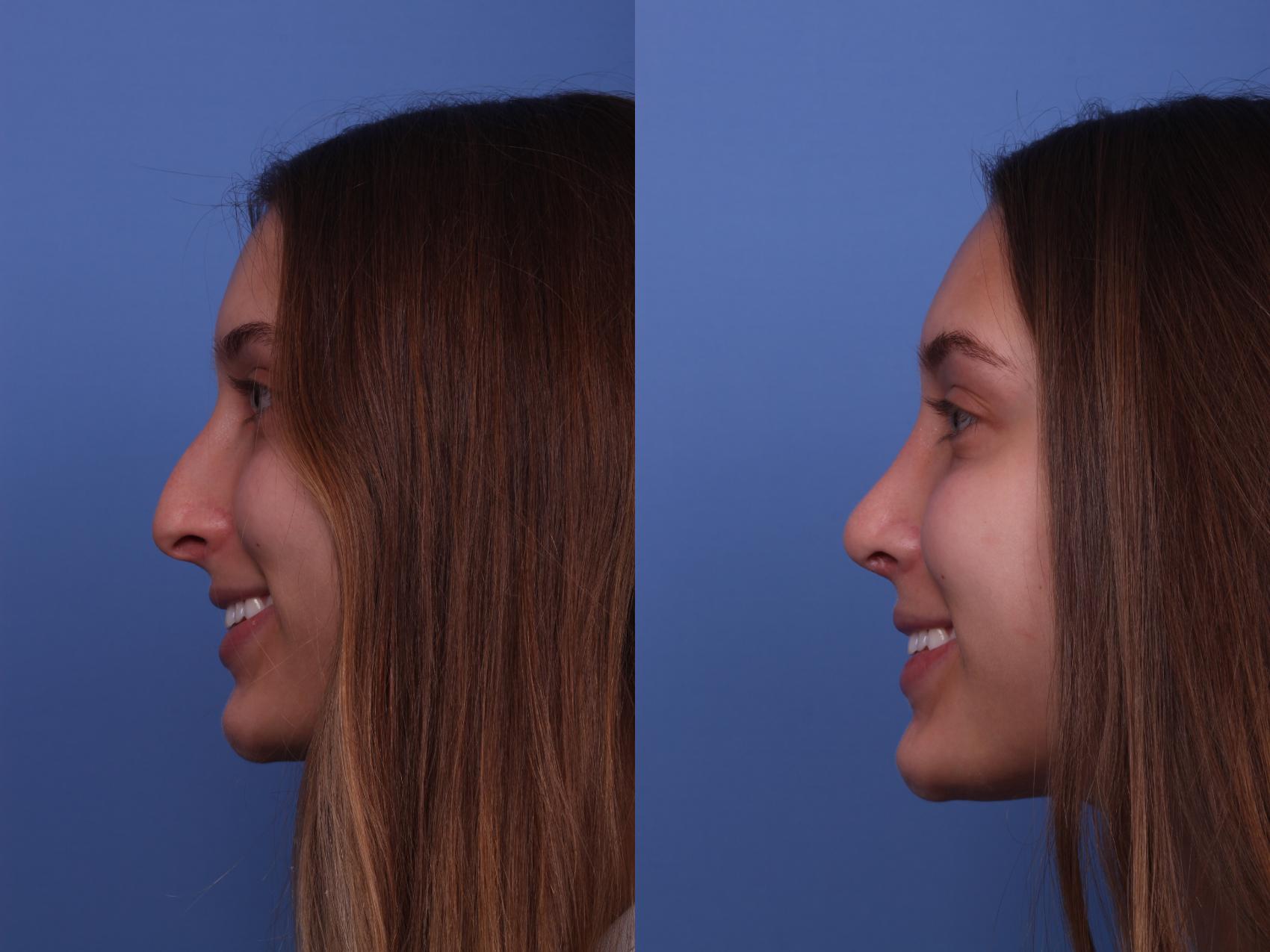 Before & After Rhinoplasty Case 356 Left Smile View in Scottsdale, AZ