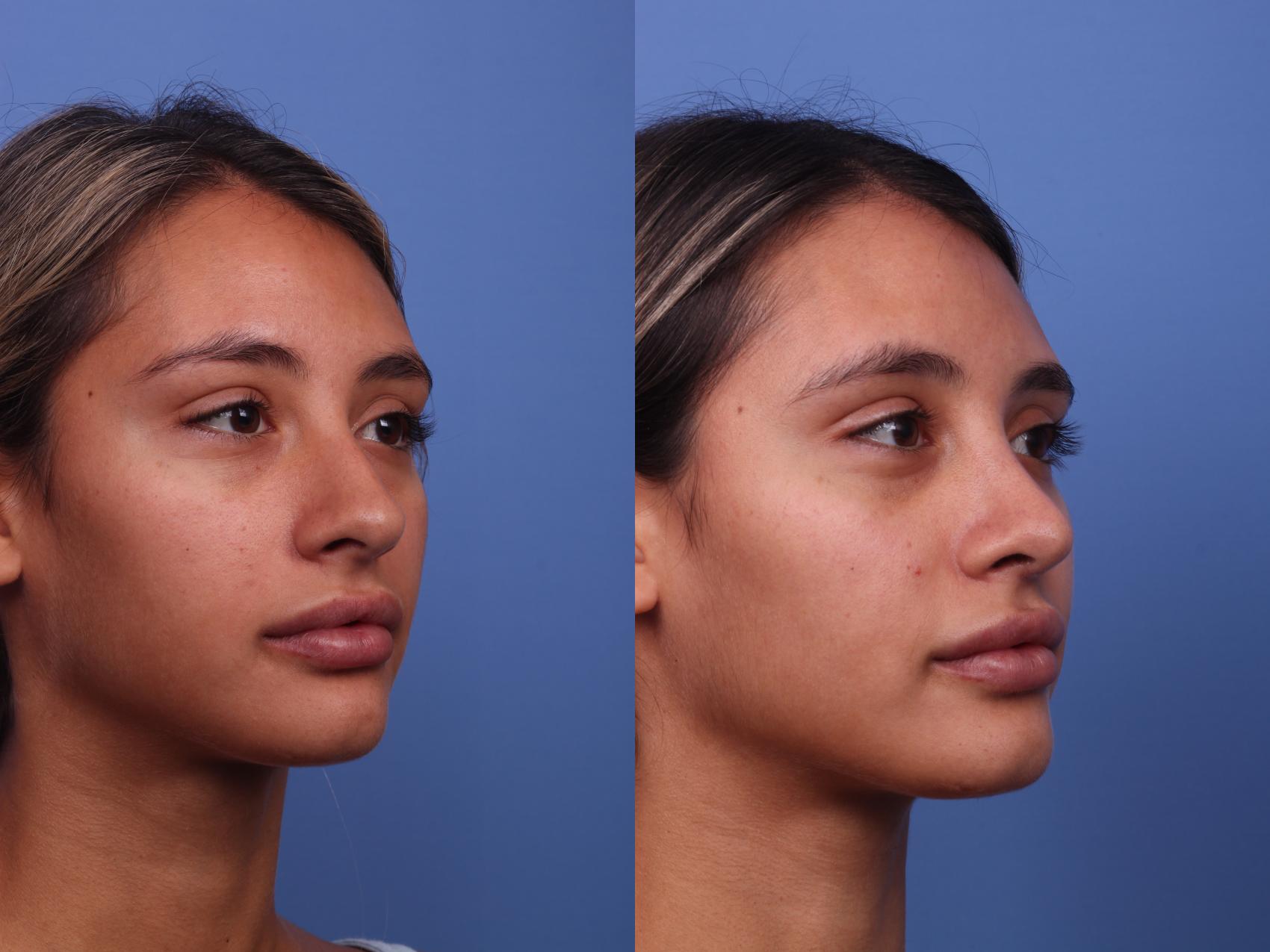 Before & After Rhinoplasty Case 357 Right Oblique View in Scottsdale, AZ