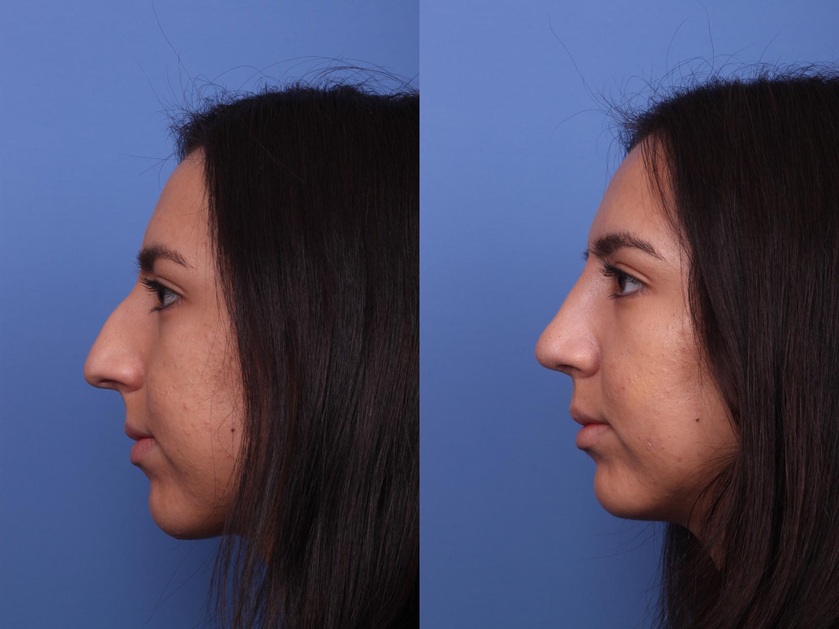 Before & After Rhinoplasty Case 358 Left Side View in Scottsdale, AZ