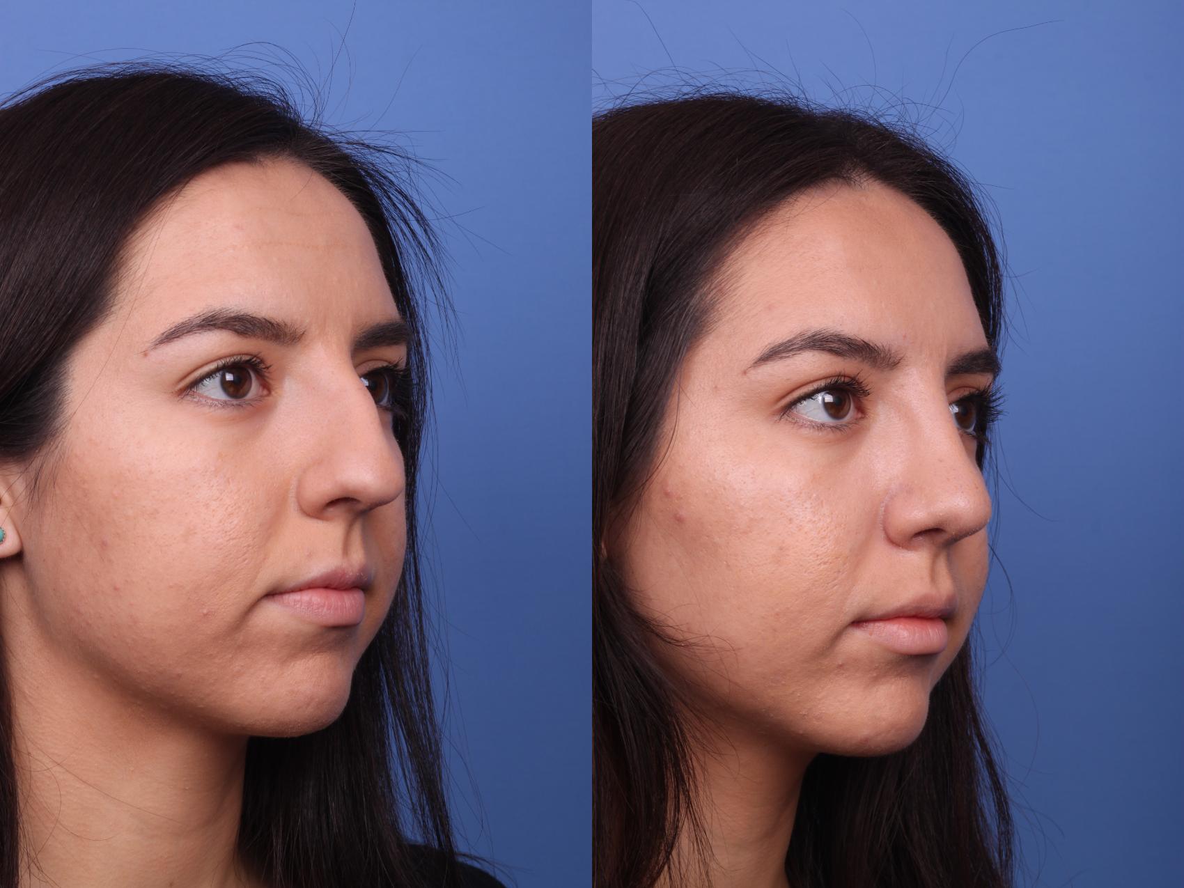 Before & After Rhinoplasty Case 358 Right Oblique View in Scottsdale, AZ
