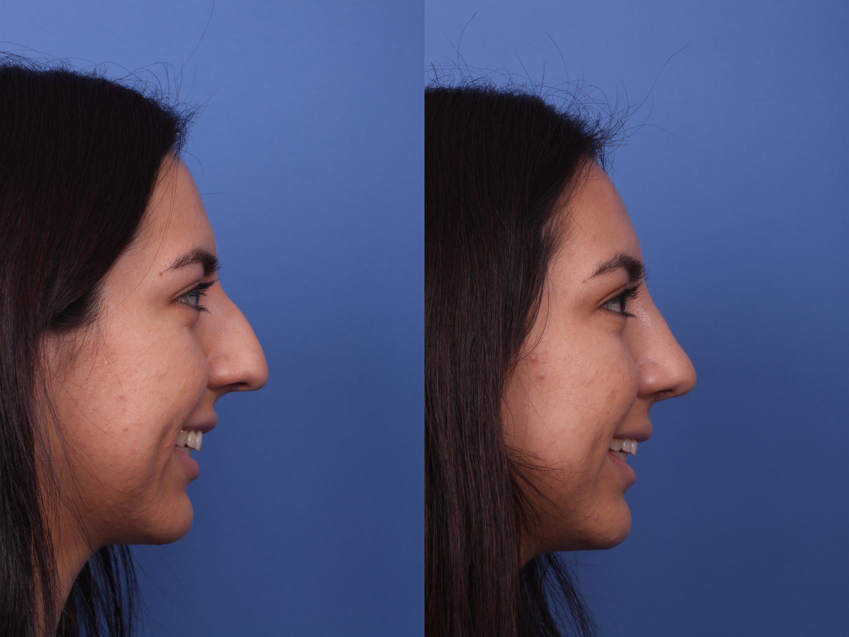 Before & After Rhinoplasty Case 358 Right Smile View in Scottsdale, AZ