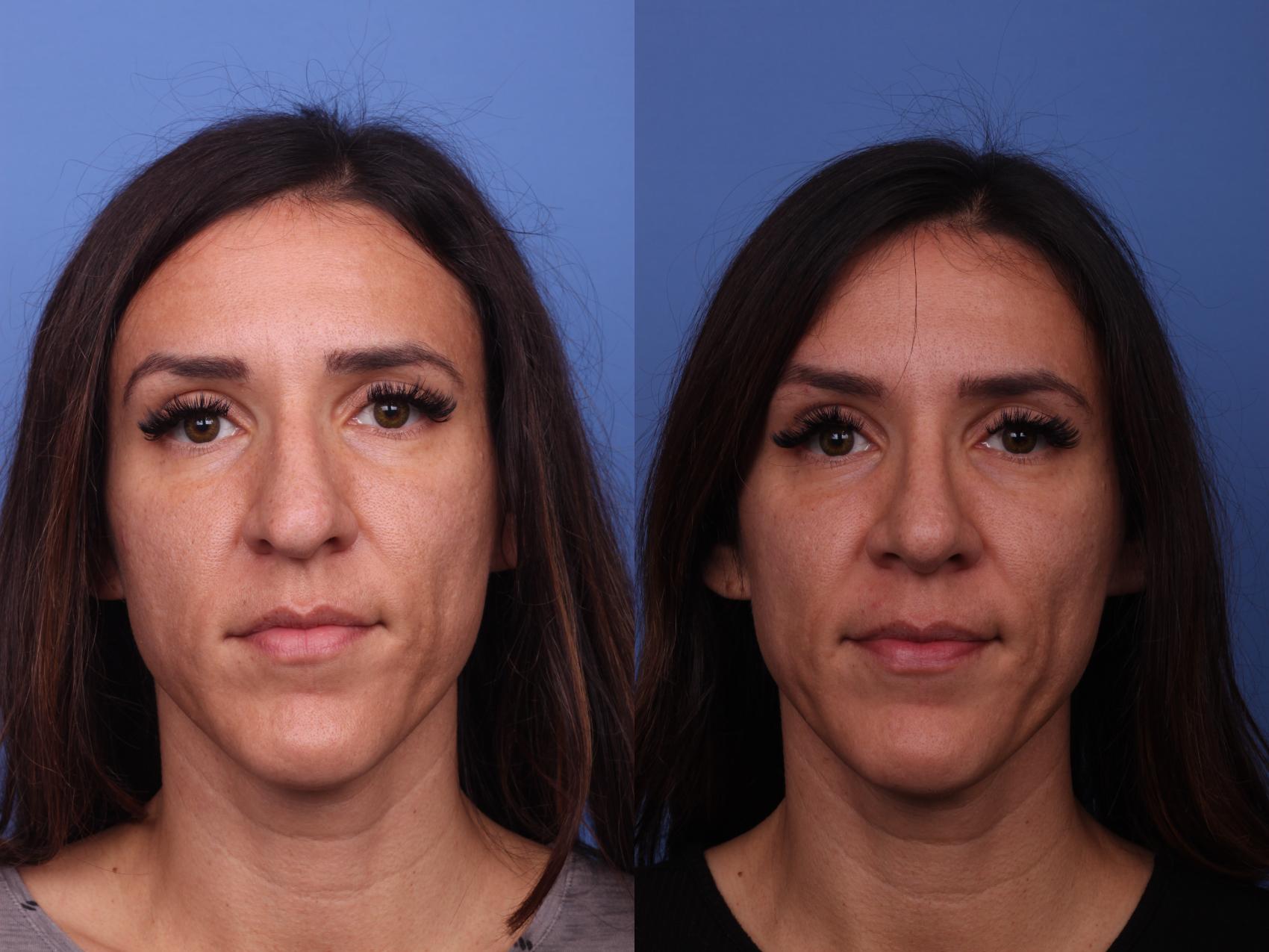 Before & After Rhinoplasty Case 359 Front View in Scottsdale, AZ