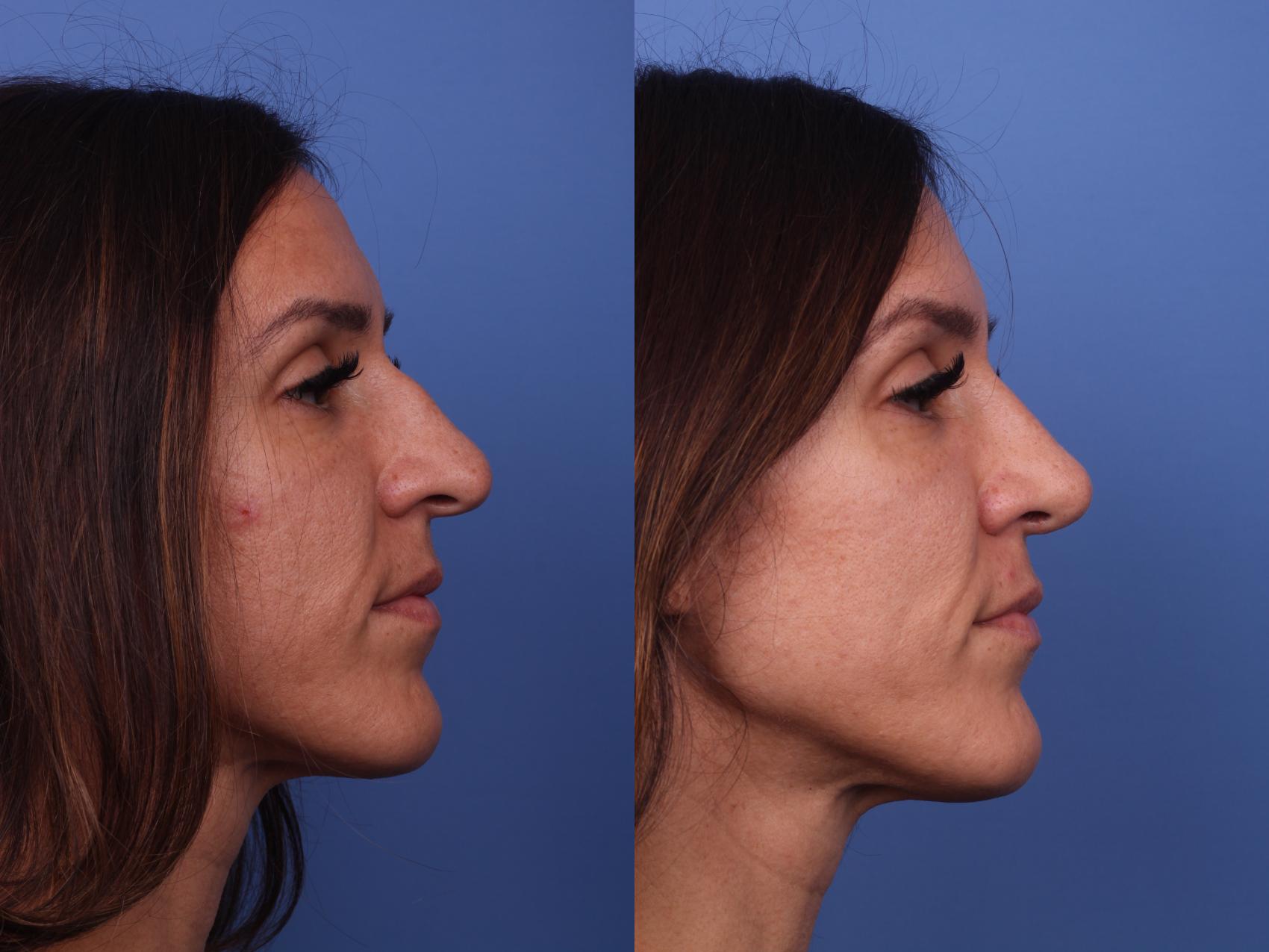 Before & After Rhinoplasty Case 359 Right Side View in Scottsdale, AZ