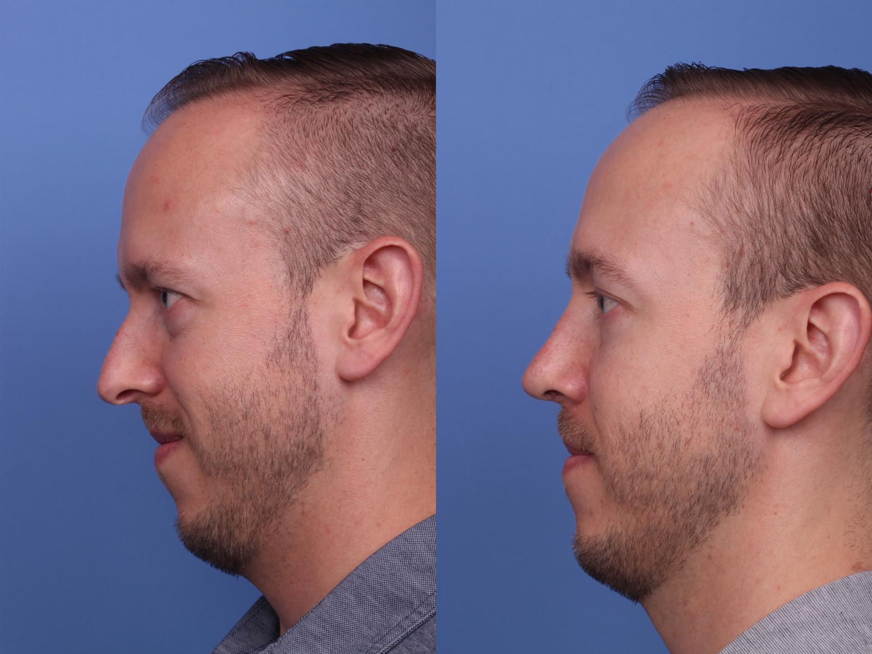Before & After Rhinoplasty Case 360 Left Side View in Scottsdale, AZ