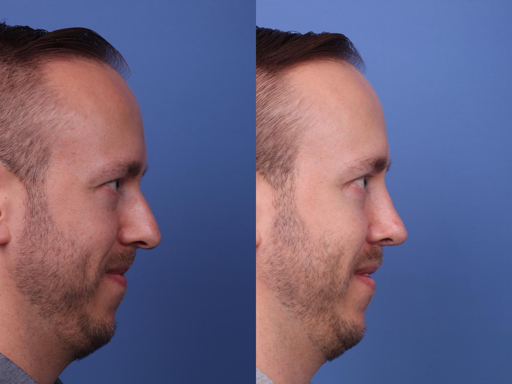 Before & After Rhinoplasty Case 360 Right Side View in Scottsdale, AZ