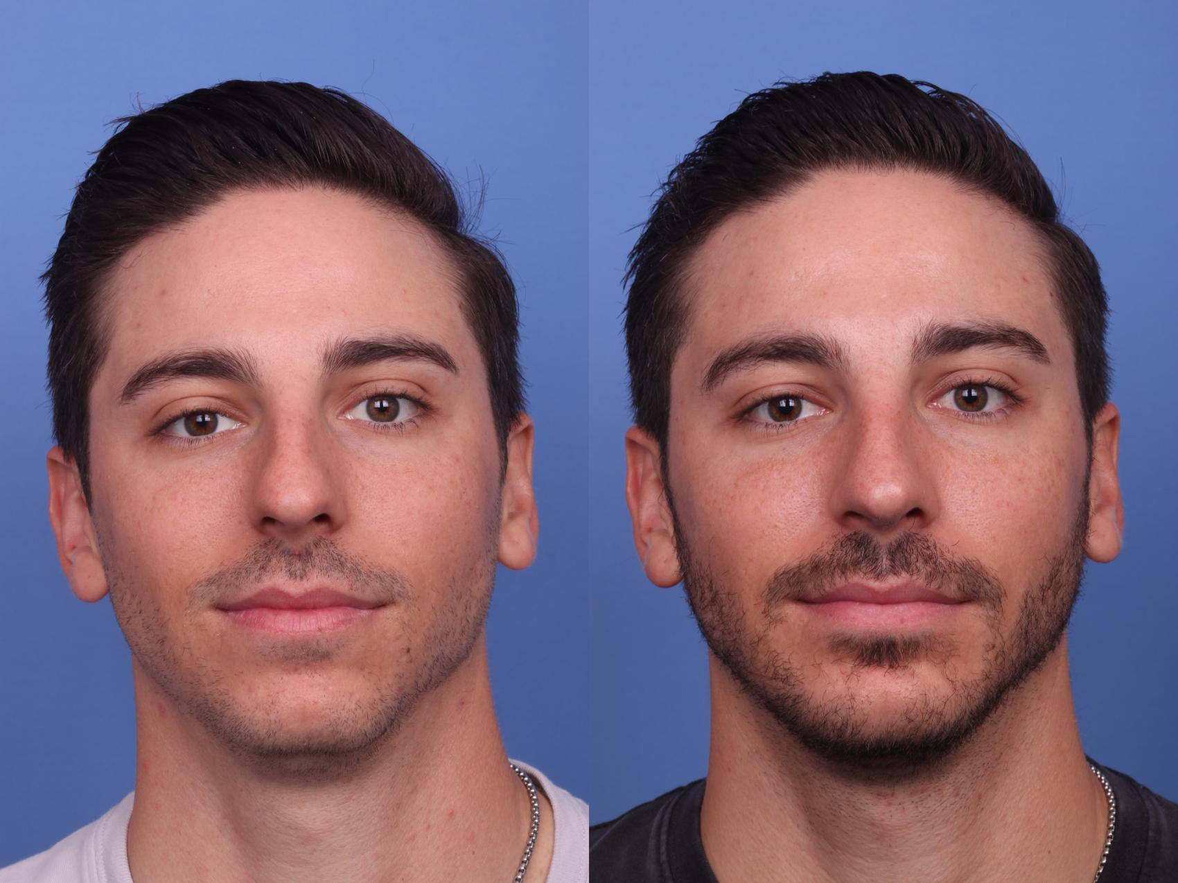 Before & After Rhinoplasty Case 362 Front View in Scottsdale, AZ