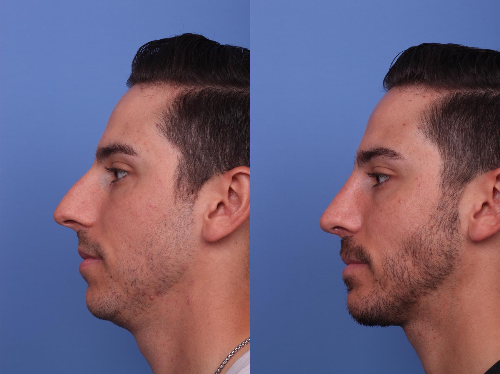 Before & After Rhinoplasty Case 362 Left Side View in Scottsdale, AZ