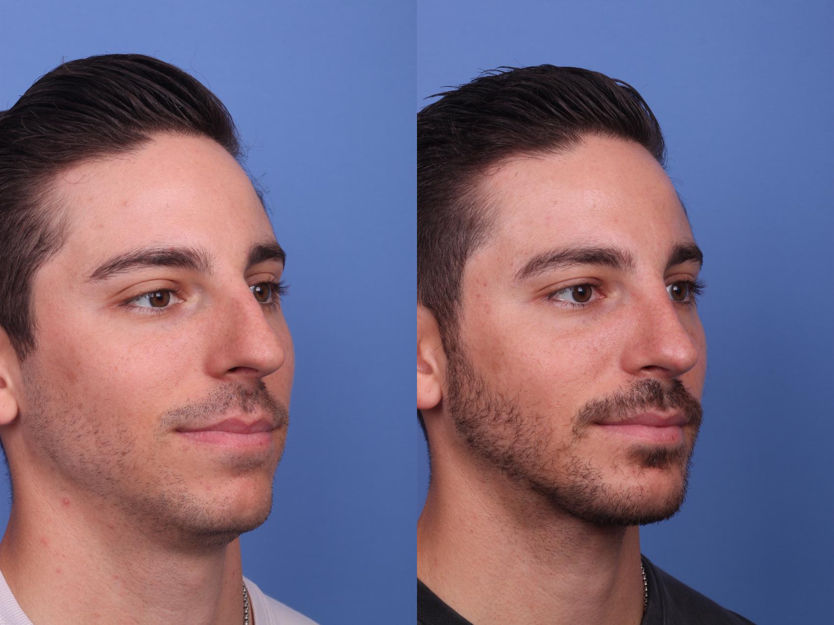 Before & After Rhinoplasty Case 362 Right Oblique View in Scottsdale, AZ