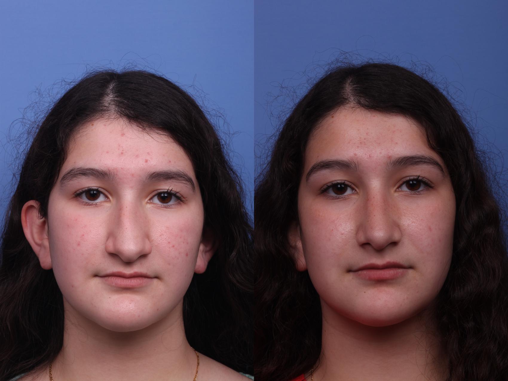 Before & After Rhinoplasty Case 363 Front View in Scottsdale, AZ