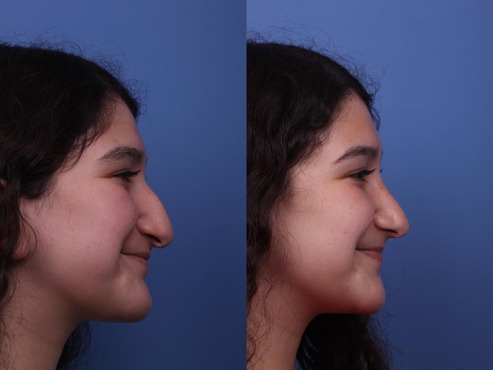 Before & After Rhinoplasty Case 363 Right Smile View in Scottsdale, AZ