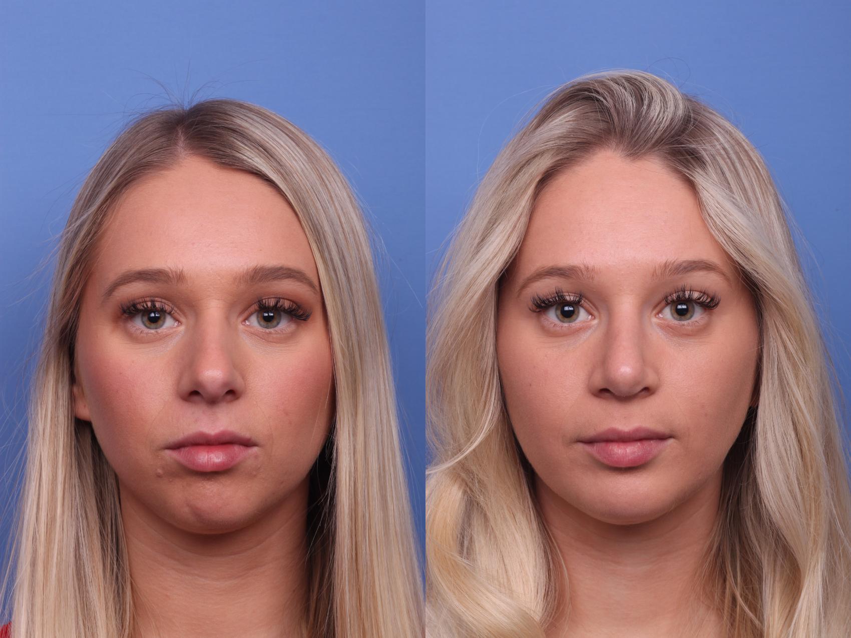 Before & After Rhinoplasty Case 364 Front View in Scottsdale, AZ