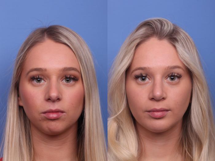 Chin Implant Before & After Photo | Scottsdale & Phoenix, AZ | Hobgood Facial Plastic Surgery: Todd Hobgood, MD