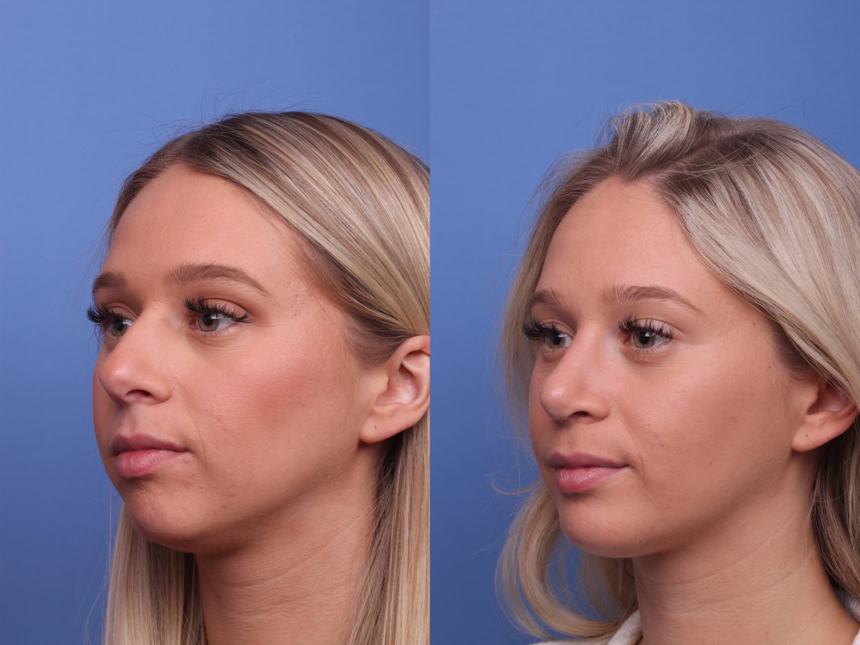 Before & After Rhinoplasty Case 364 Left Oblique View in Scottsdale, AZ