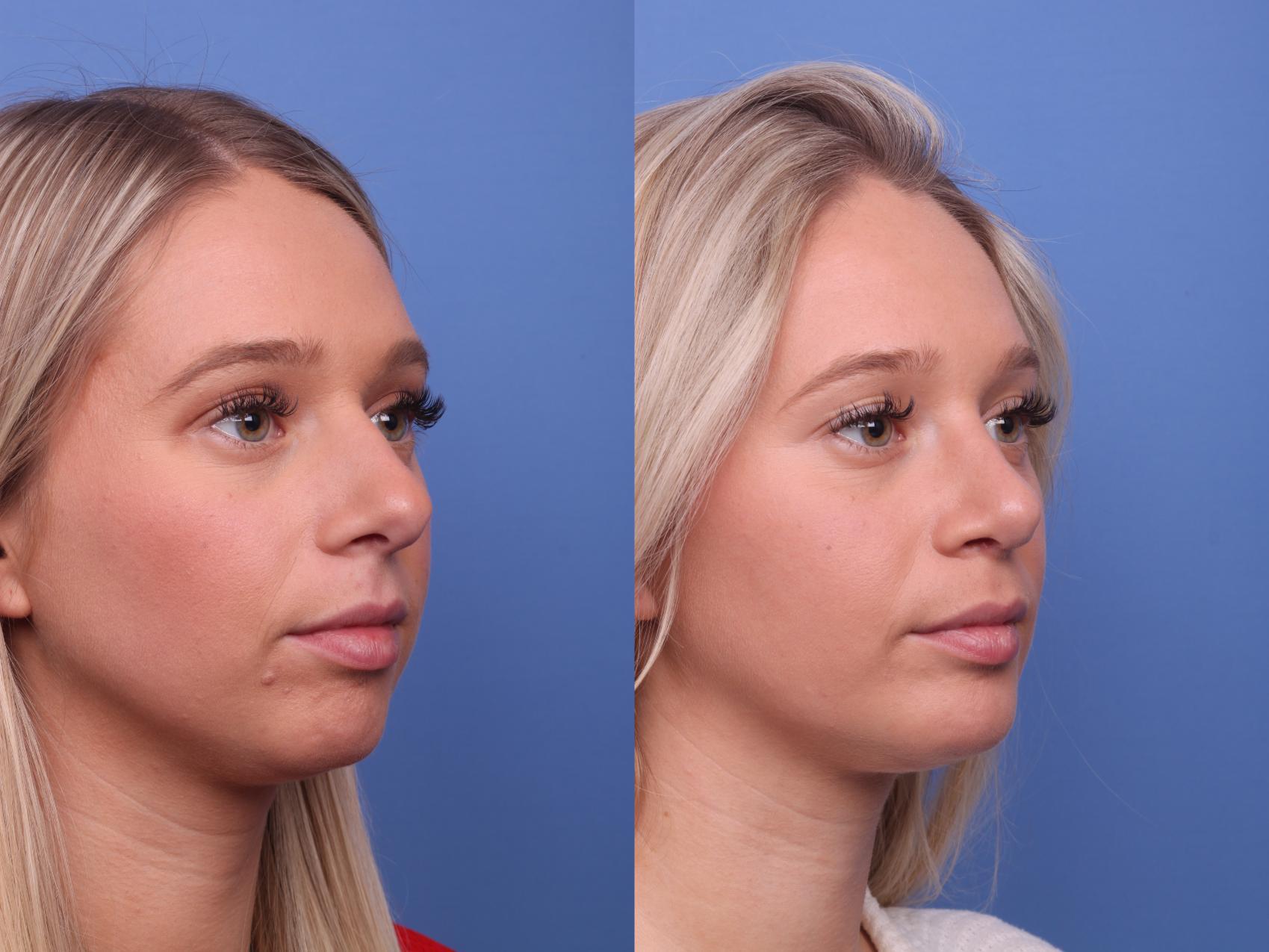 Before & After Rhinoplasty Case 364 Right Oblique View in Scottsdale, AZ