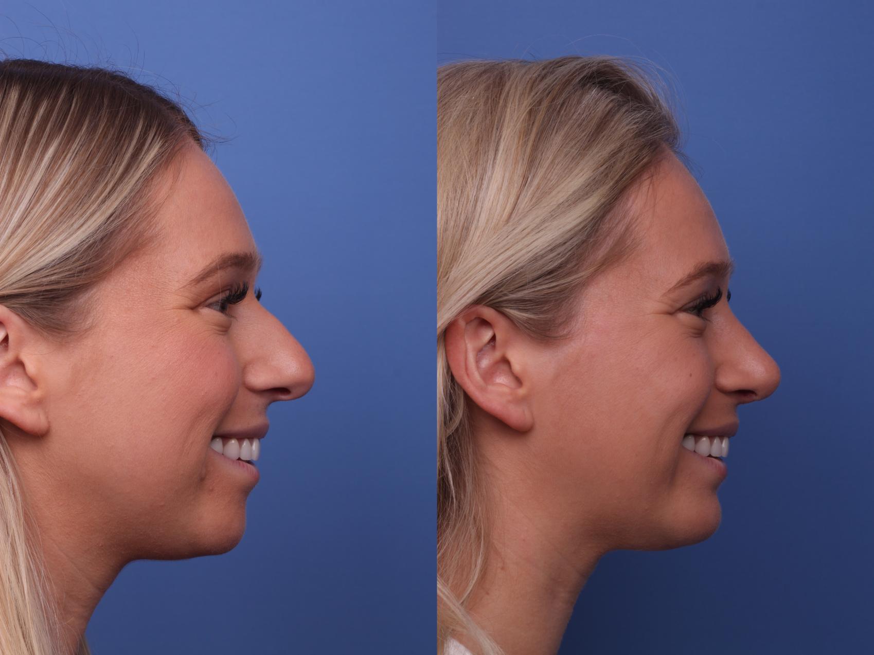 Before & After Rhinoplasty Case 364 Right Smile View in Scottsdale, AZ