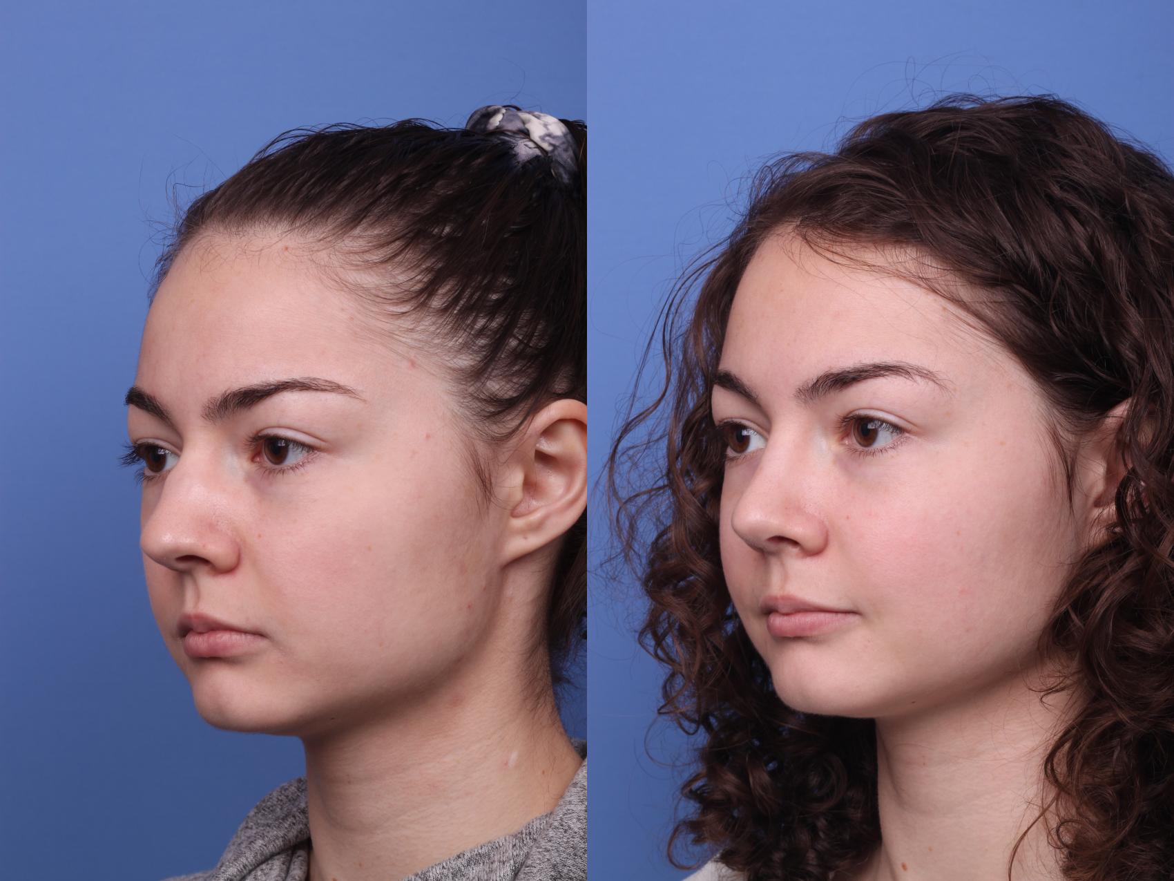 Before & After Rhinoplasty Case 366 Left Oblique View in Scottsdale, AZ