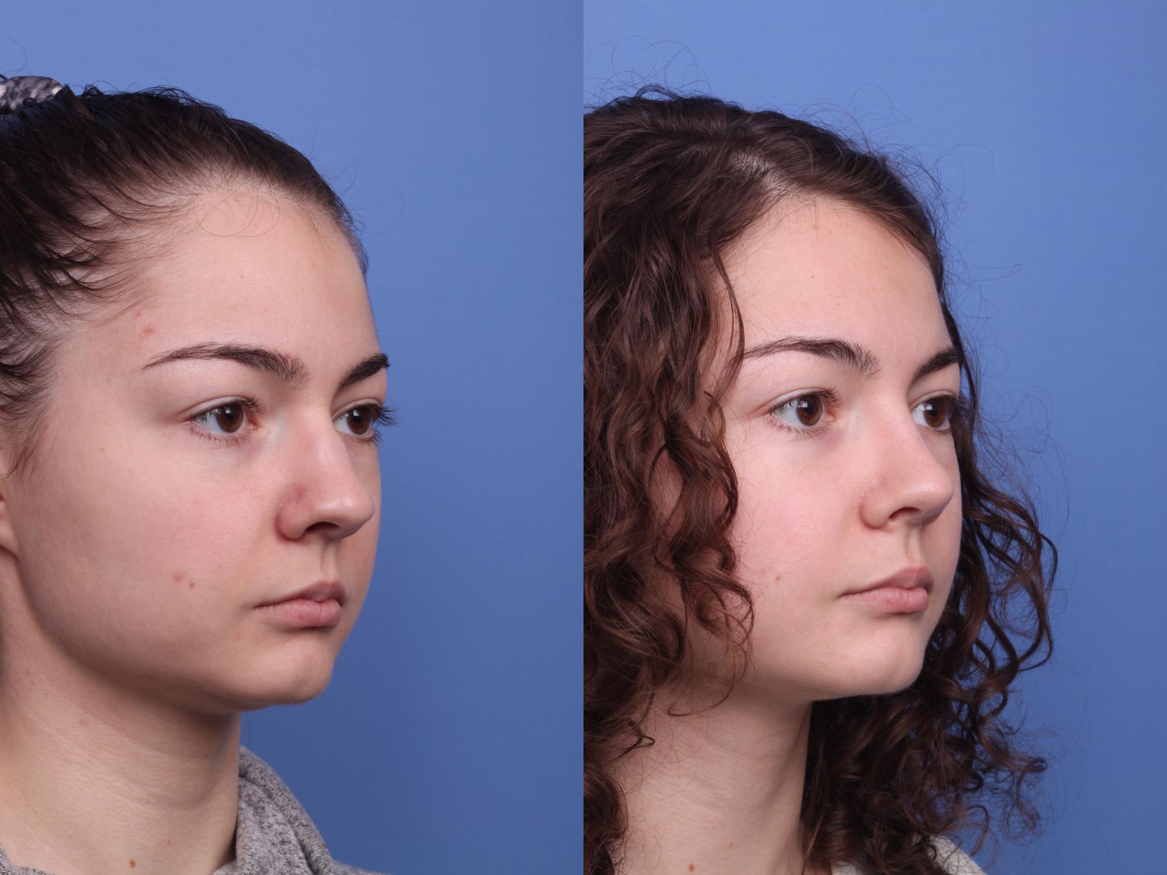 Before & After Rhinoplasty Case 366 Right Oblique View in Scottsdale, AZ