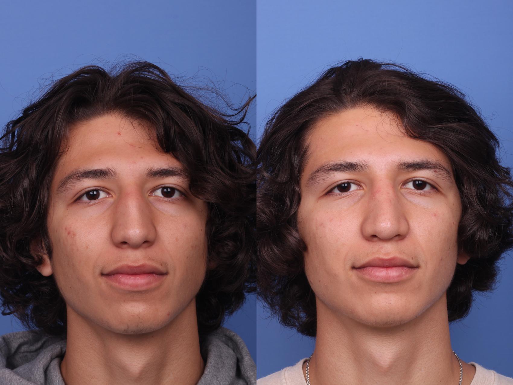 Before & After Ethnic Rhinoplasty Case 368 Front View in Scottsdale, AZ