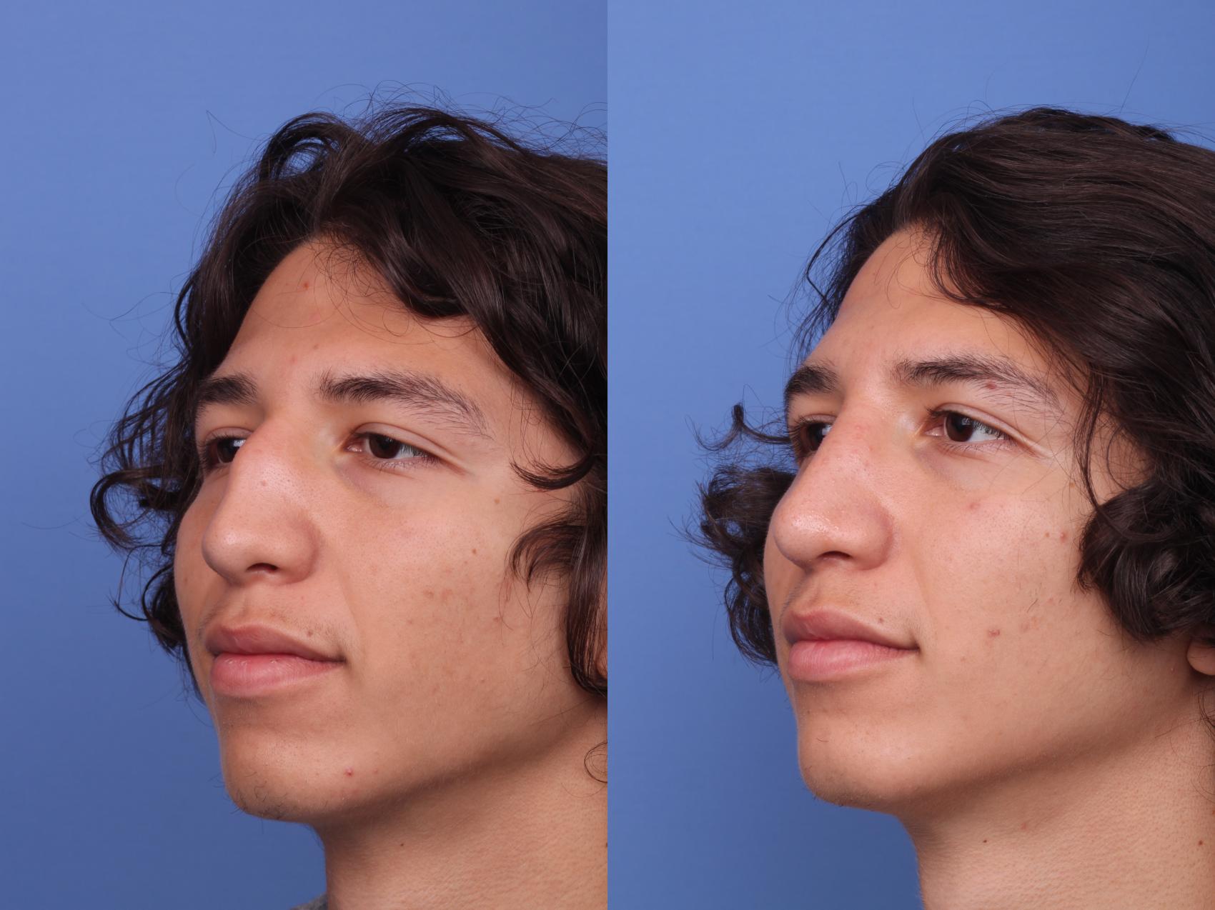 Before & After Ethnic Rhinoplasty Case 368 Left Oblique View in Scottsdale, AZ