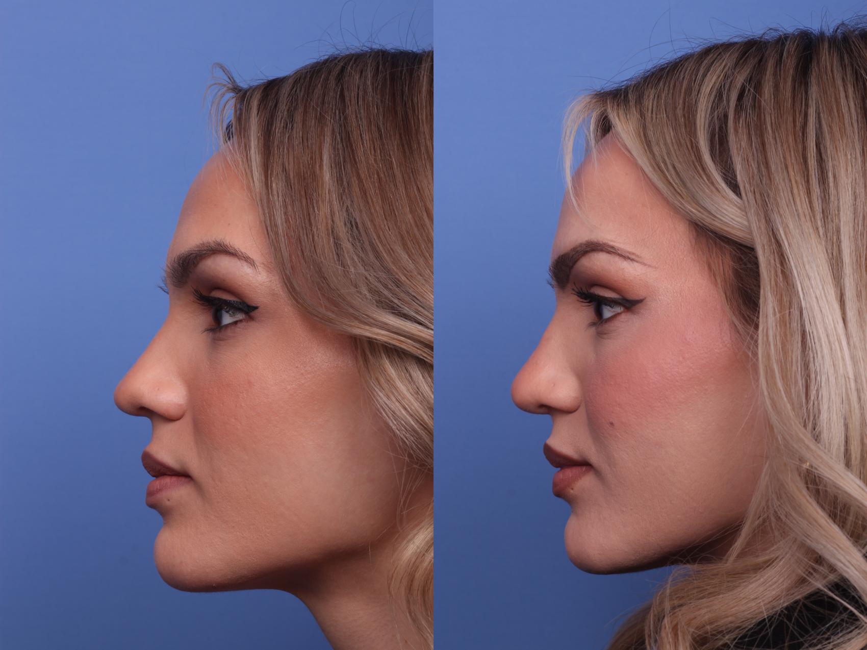 Before & After Rhinoplasty Case 371 Left Side View in Scottsdale, AZ