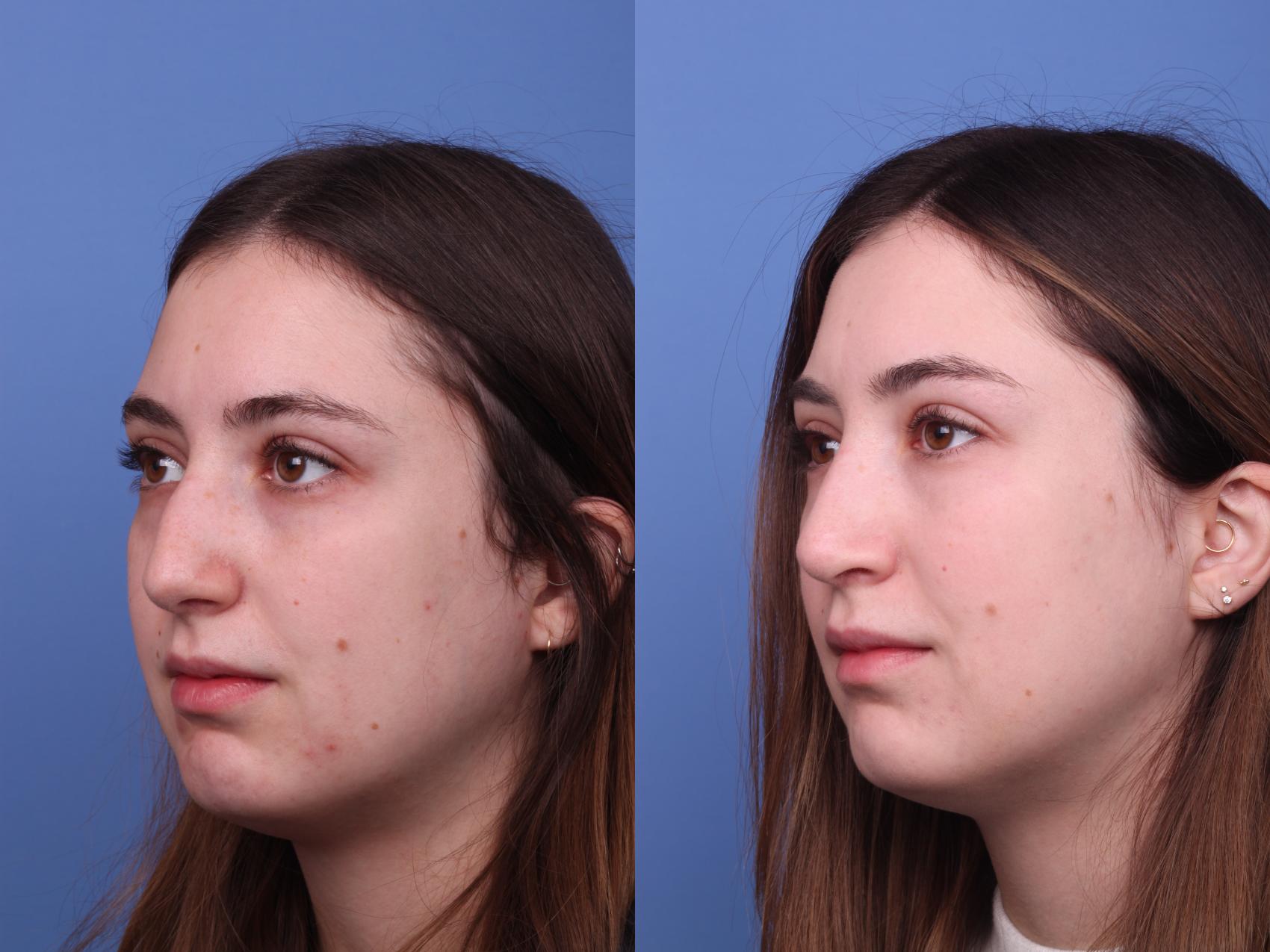 Before & After Rhinoplasty Case 372 Left Oblique View in Scottsdale, AZ