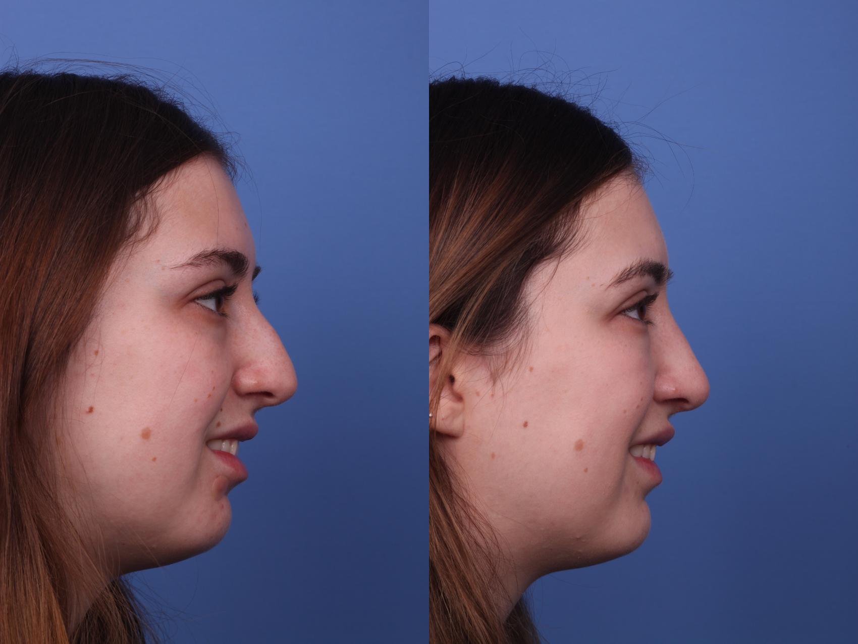 Before & After Rhinoplasty Case 372 Right Smile View in Scottsdale, AZ