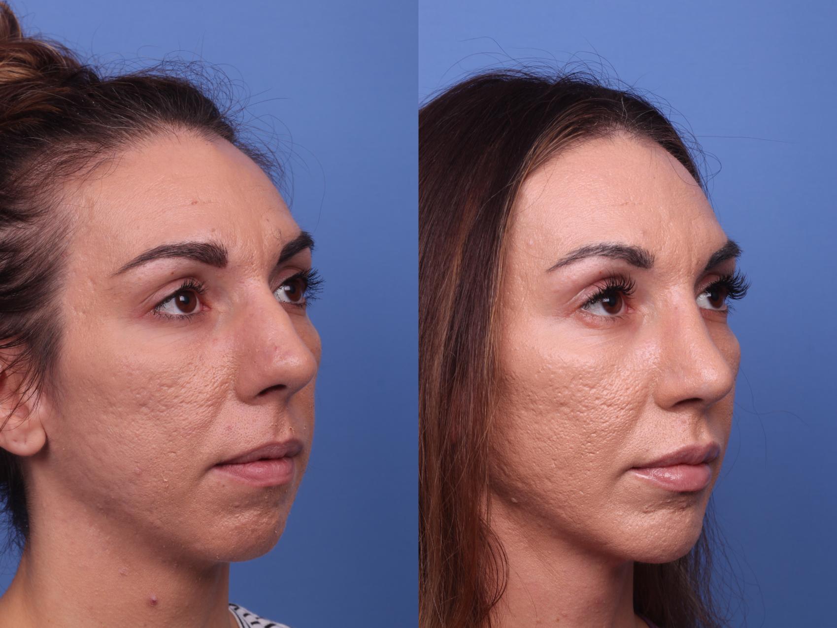 Before & After Rhinoplasty Case 375 Right Oblique View in Scottsdale, AZ