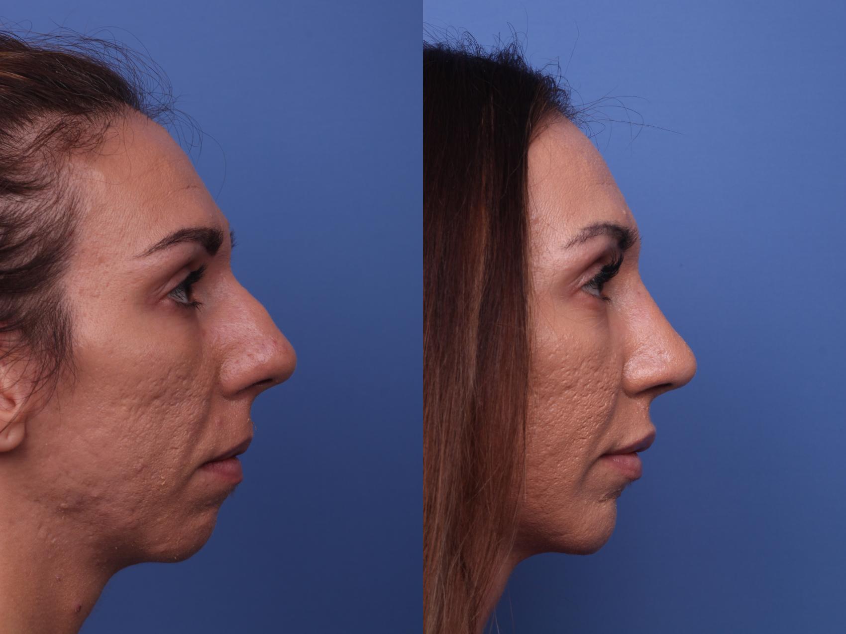 Before & After Rhinoplasty Case 375 Right Side View in Scottsdale, AZ