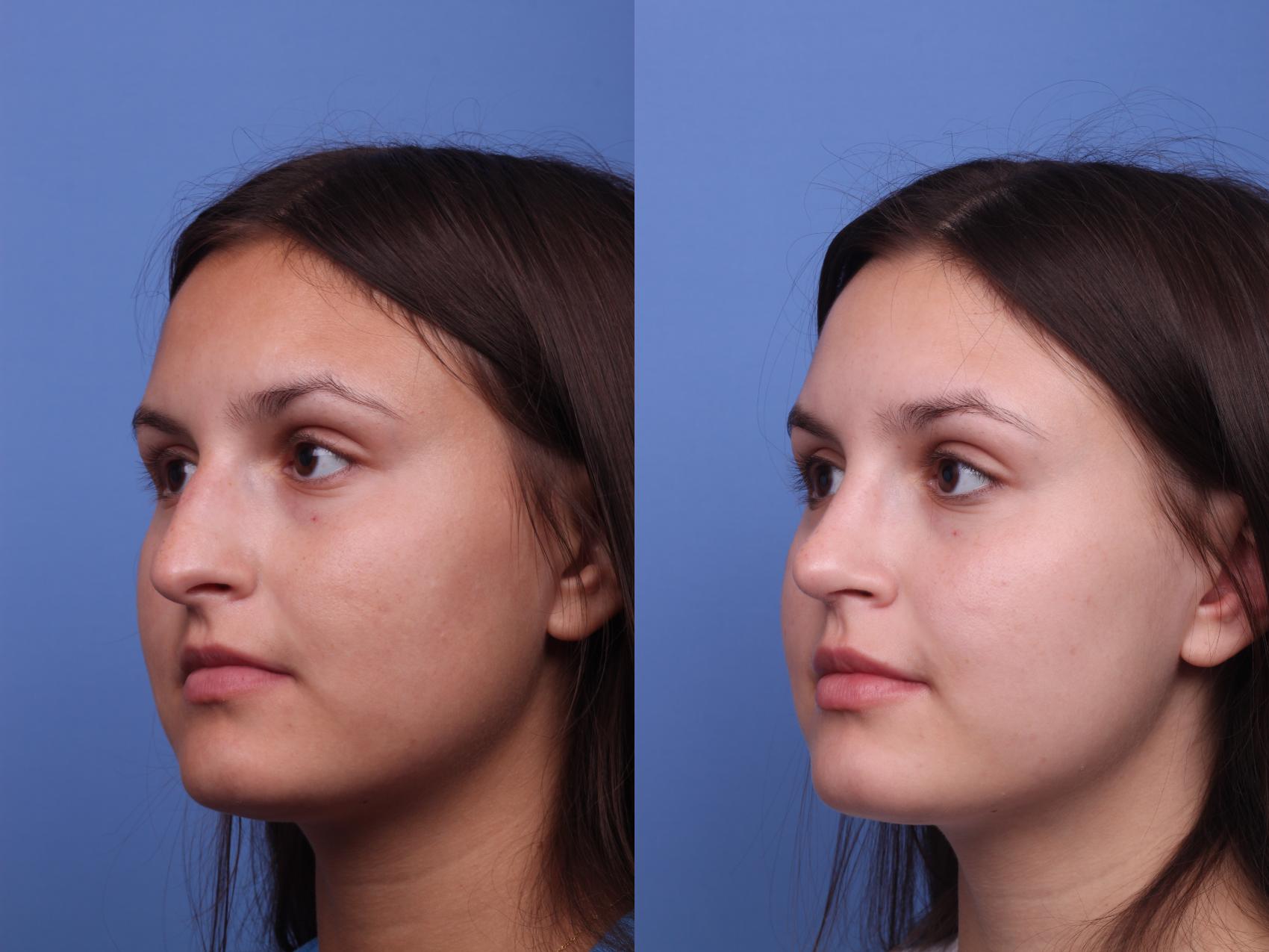 Before & After Rhinoplasty Case 376 Left Oblique View in Scottsdale, AZ