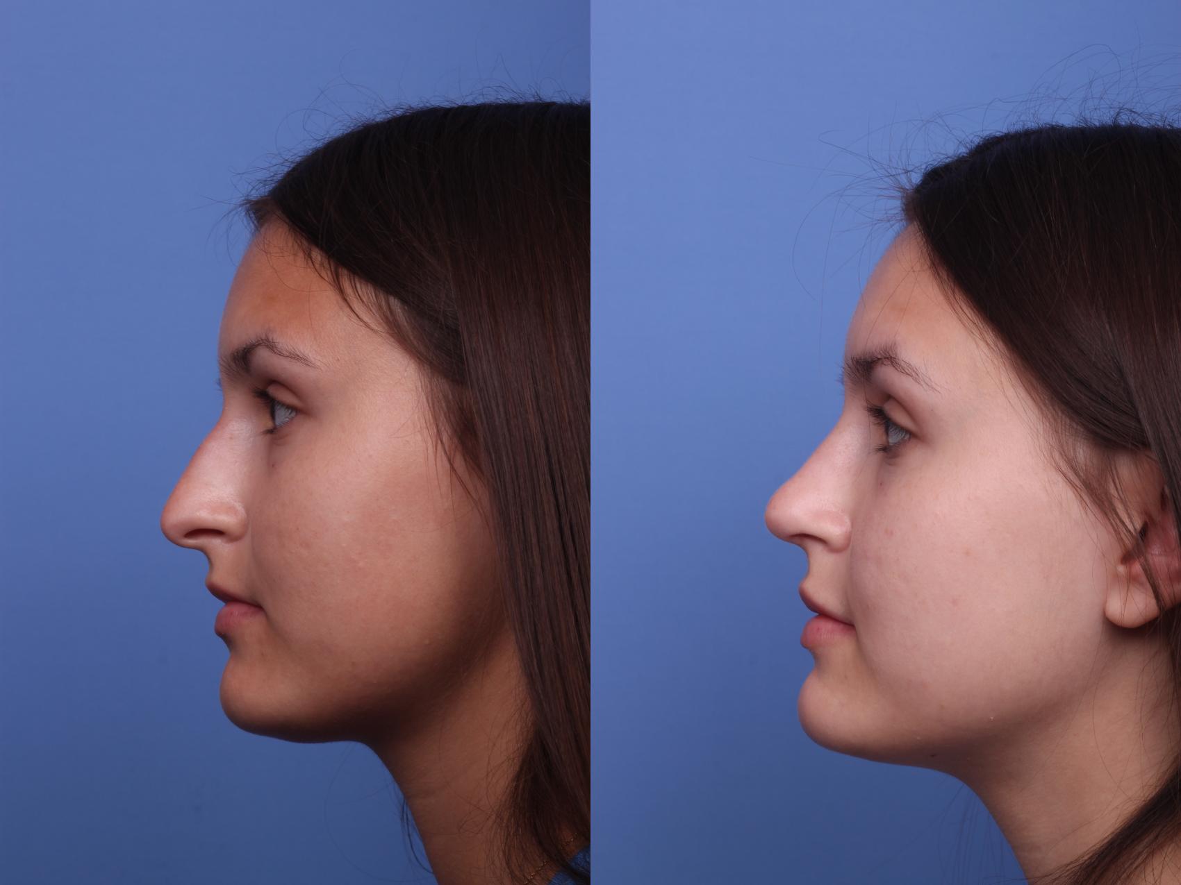 Rhinoplasty Before & After Photo | Scottsdale & Phoenix, AZ | Hobgood Facial Plastic Surgery: Todd Hobgood, MD