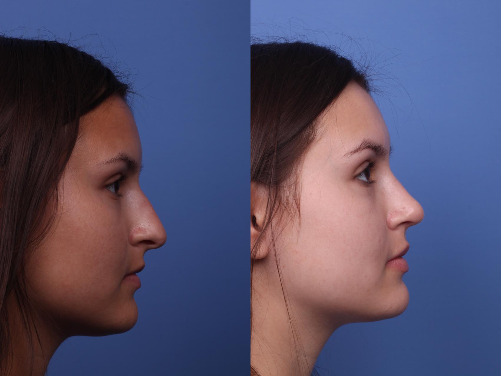 Before & After Rhinoplasty Case 376 Right Side View in Scottsdale, AZ