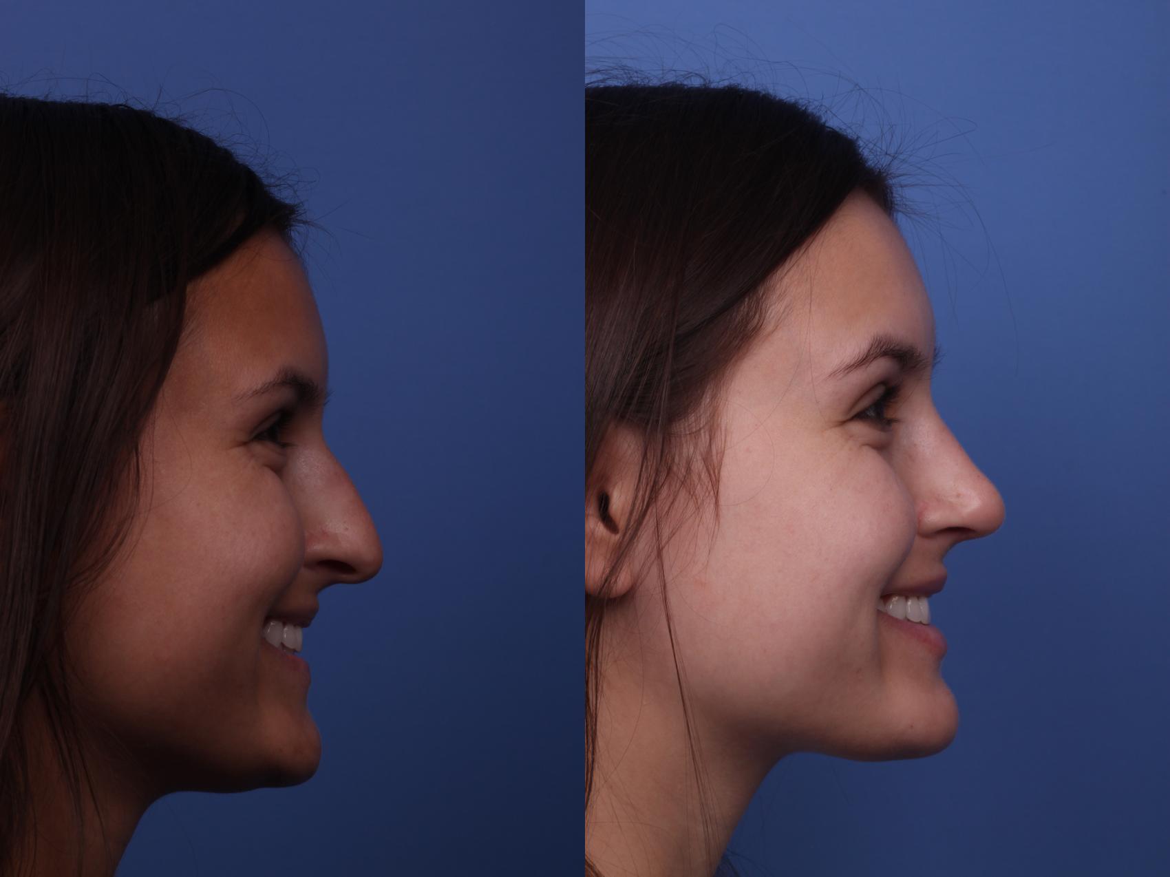 Before & After Rhinoplasty Case 376 Right Smile View in Scottsdale, AZ