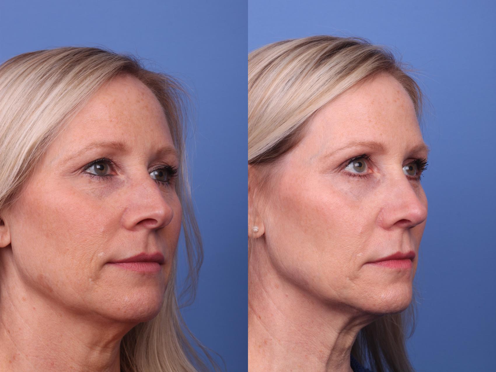 Before & After Rhinoplasty Case 377 Right Oblique View in Scottsdale, AZ