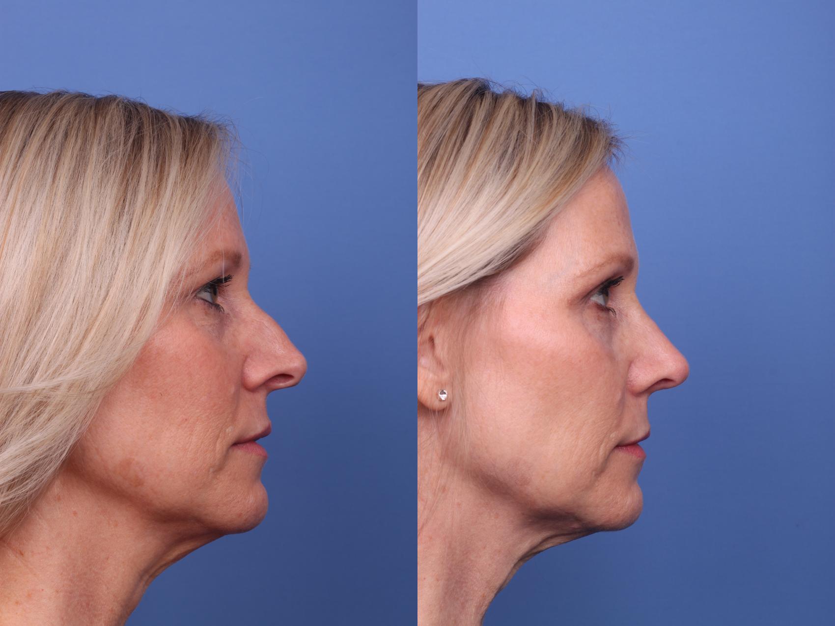 Before & After Rhinoplasty Case 377 Right Side View in Scottsdale, AZ