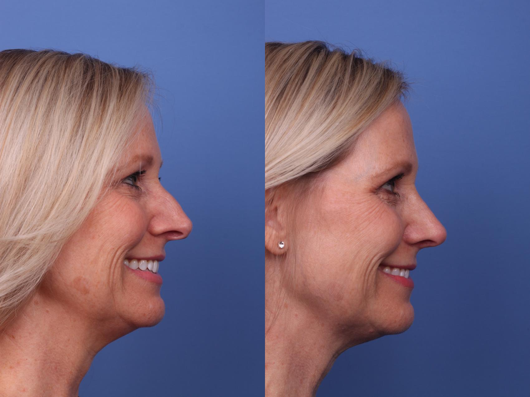 Before & After Rhinoplasty Case 377 Right Smile View in Scottsdale, AZ