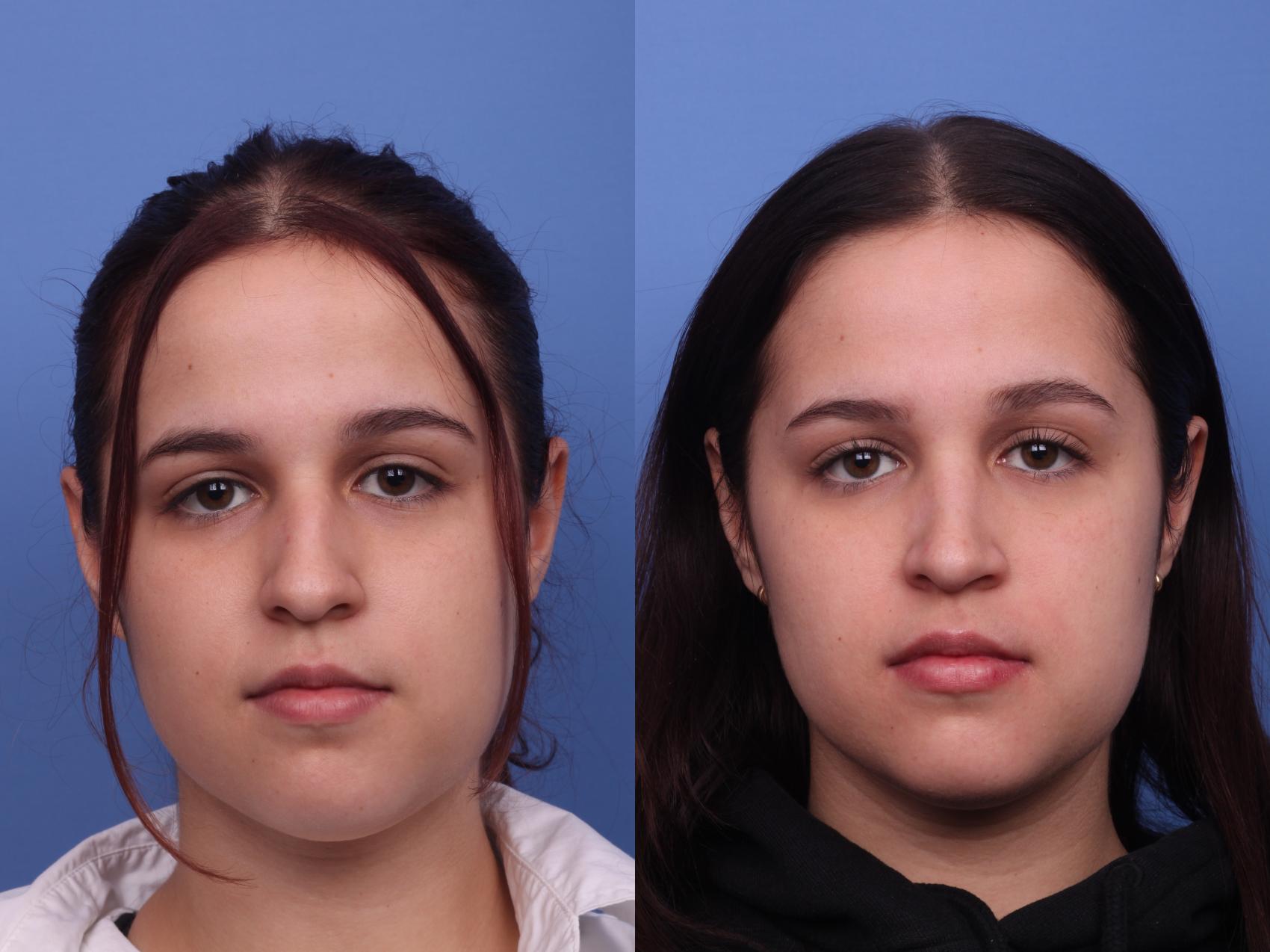 Before & After Rhinoplasty Case 378 Front View in Scottsdale, AZ