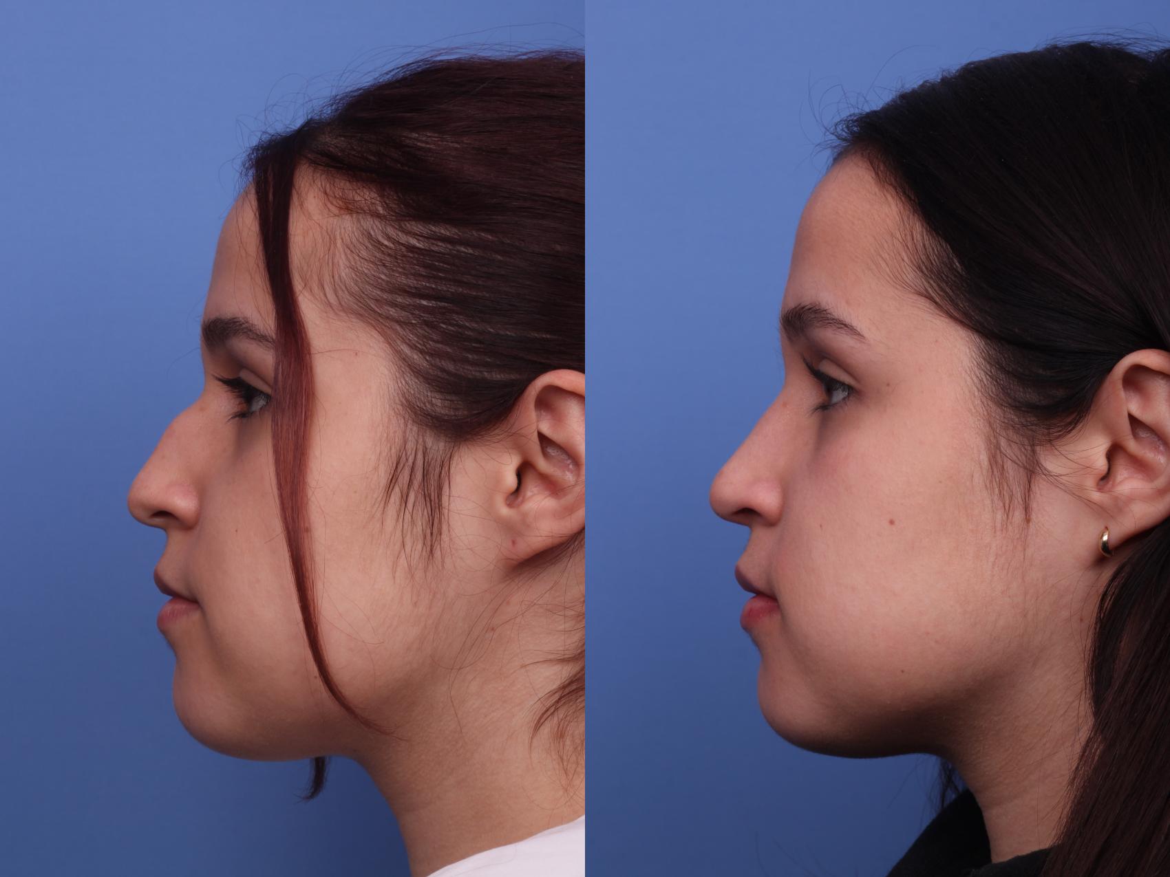 Before & After Rhinoplasty Case 378 Left Side View in Scottsdale, AZ