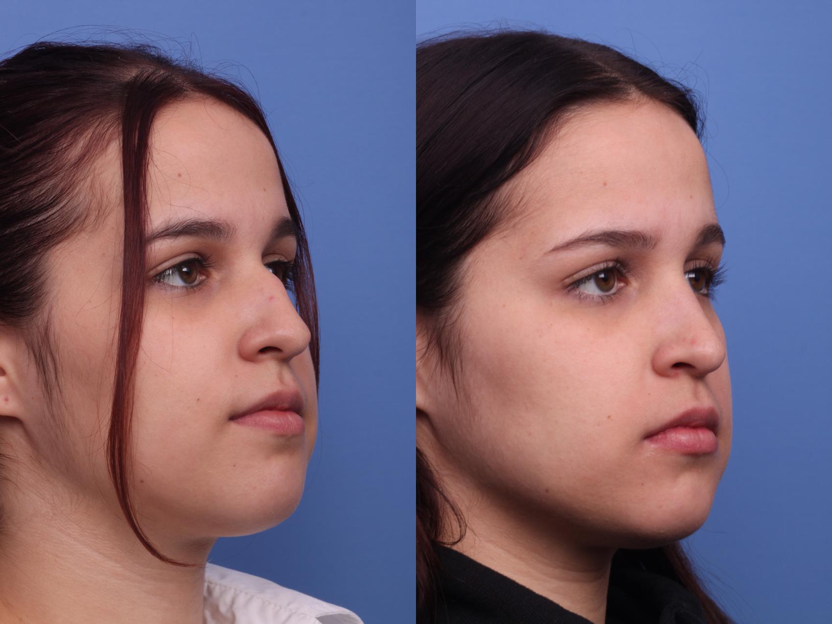 Before & After Rhinoplasty Case 378 Right Oblique View in Scottsdale, AZ