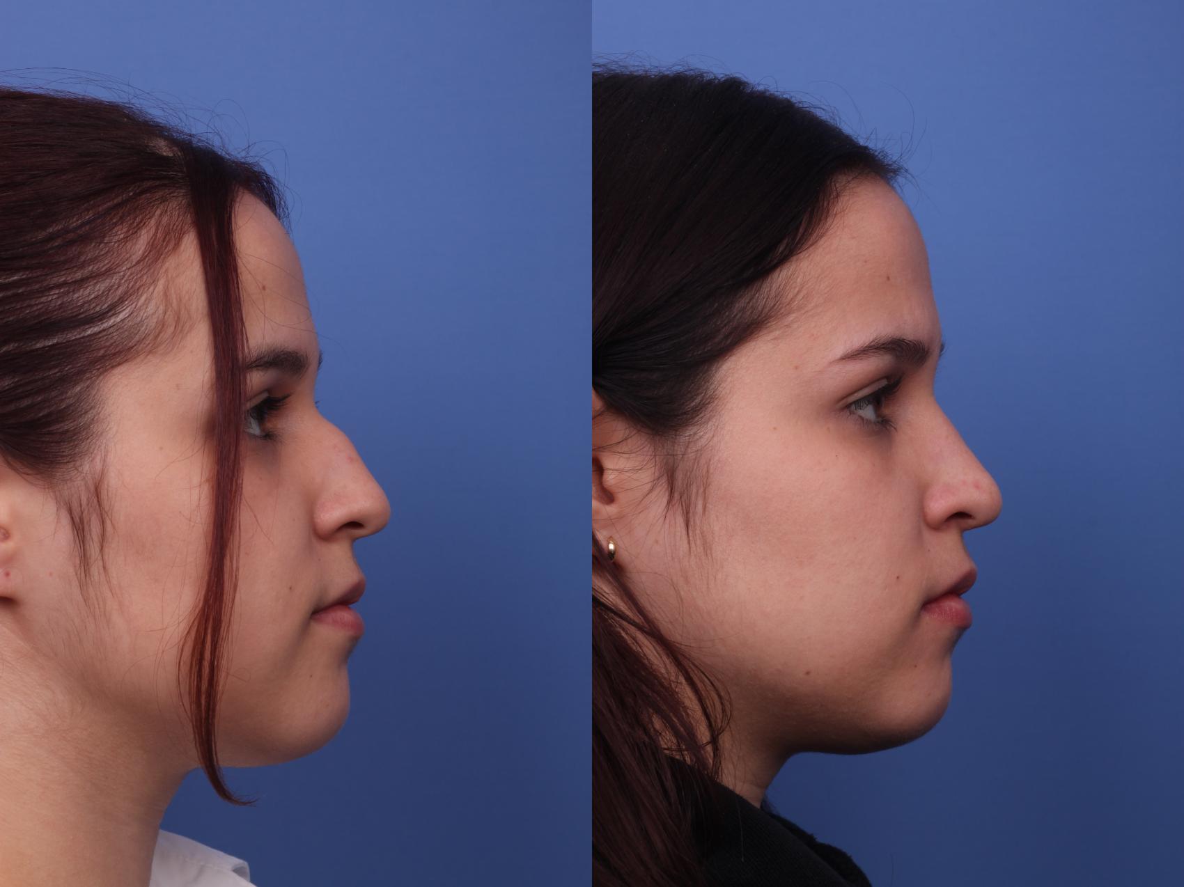 Before & After Rhinoplasty Case 378 Right Side View in Scottsdale, AZ