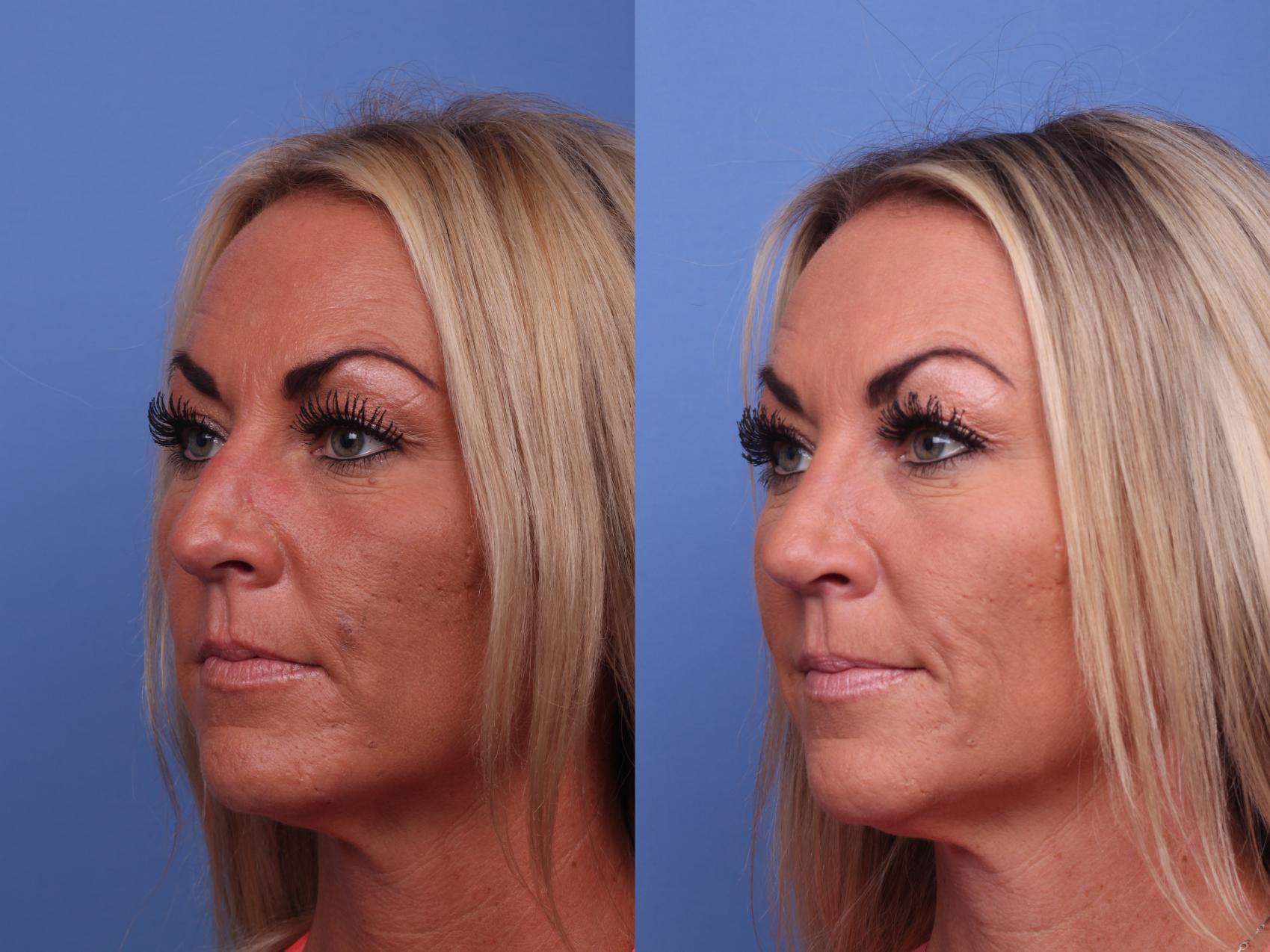Before & After Rhinoplasty Case 379 Left Oblique View in Scottsdale, AZ