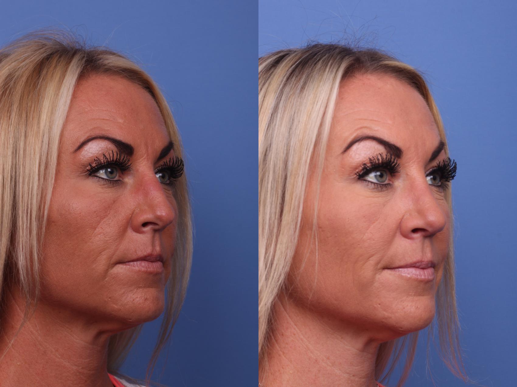 Before & After Rhinoplasty Case 379 Right Oblique View in Scottsdale, AZ