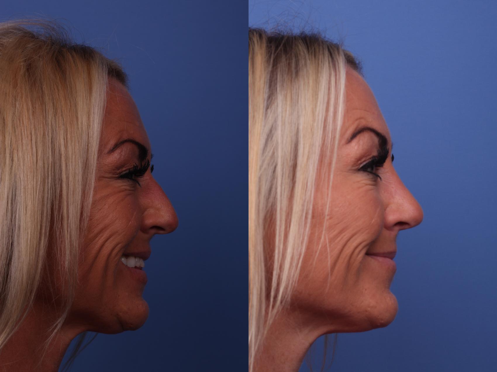 Before & After Rhinoplasty Case 379 Right Smile View in Scottsdale, AZ