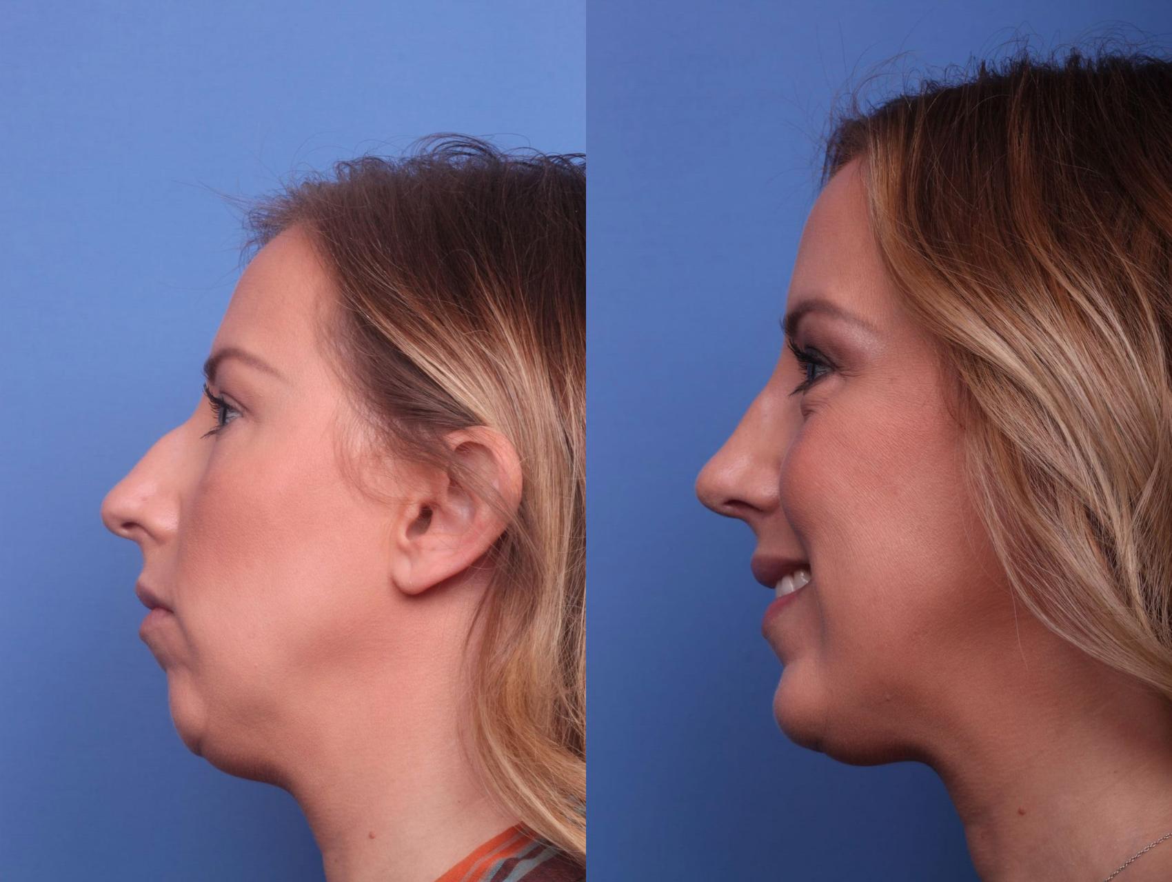 Before & After Rhinoplasty Case 38 View #2 View in Scottsdale, AZ