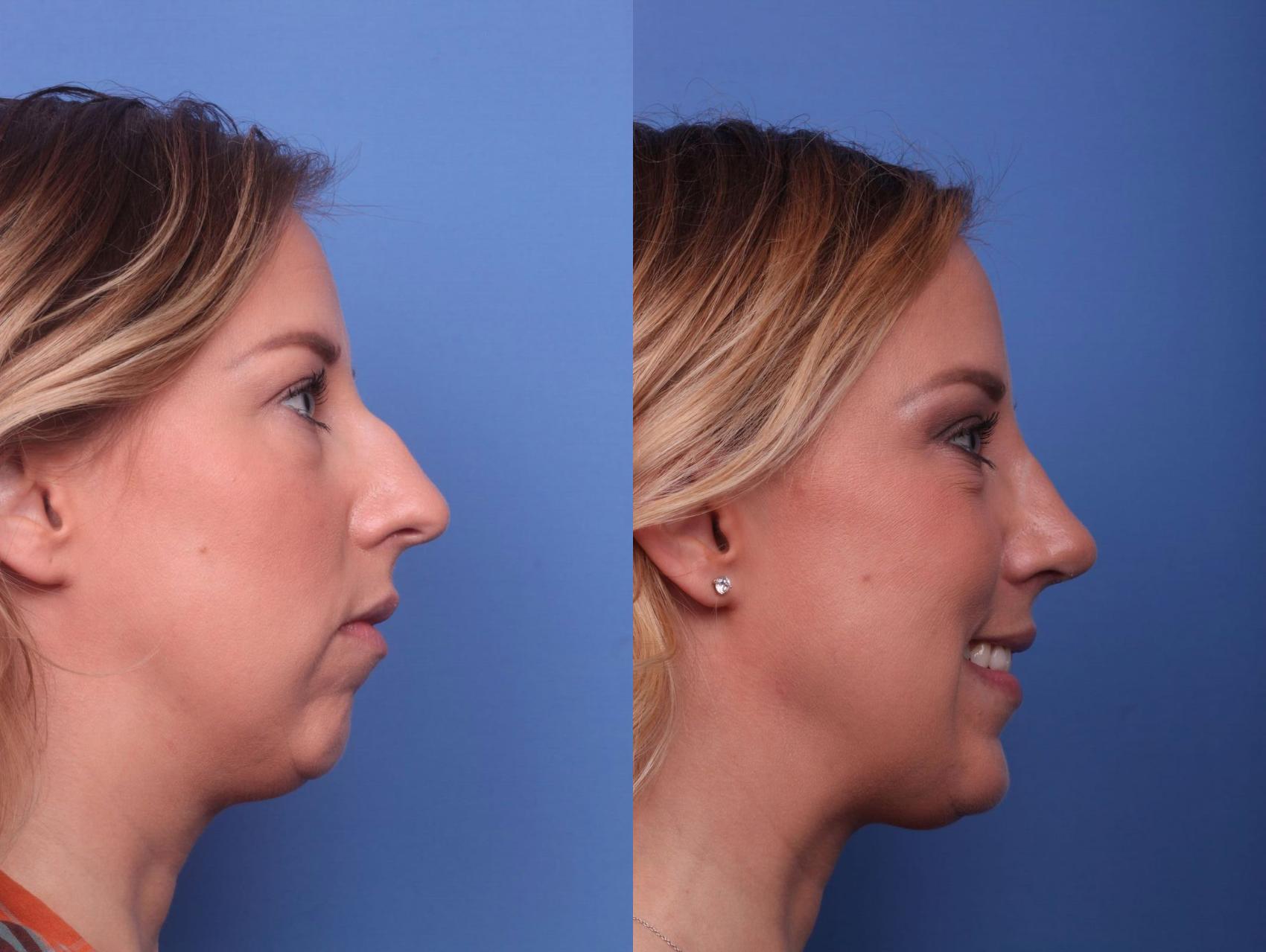 Before & After Rhinoplasty Case 38 View #3 View in Scottsdale, AZ
