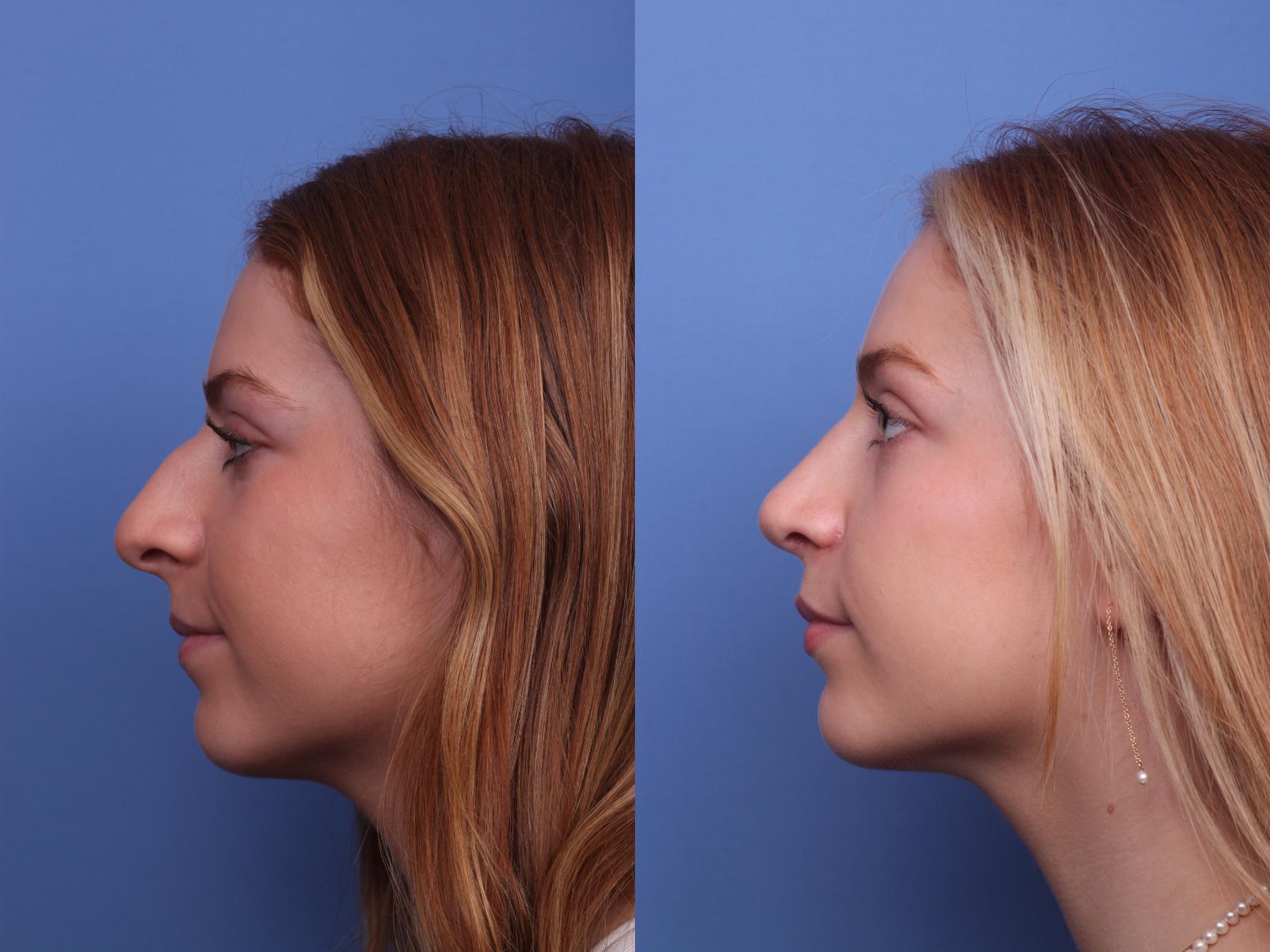 Before & After Rhinoplasty Case 380 Left Side View in Scottsdale, AZ