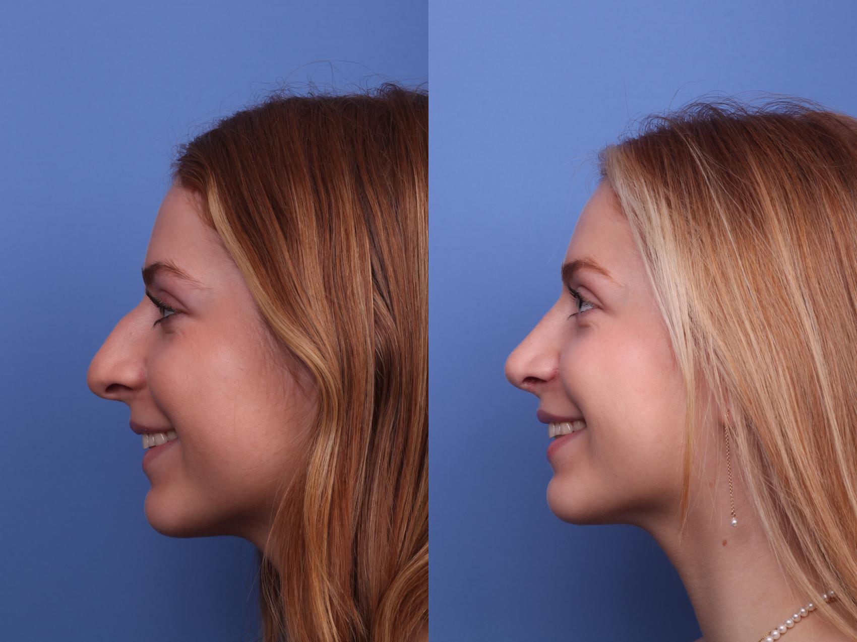 Before & After Rhinoplasty Case 380 Left Smile View in Scottsdale, AZ