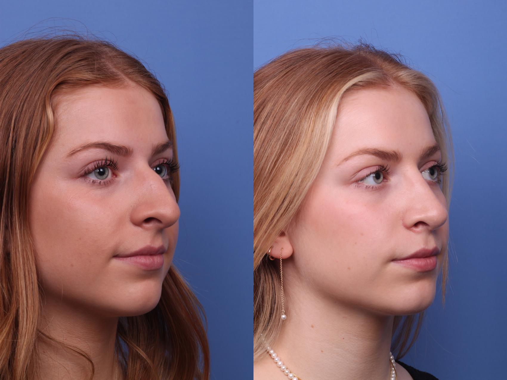 Before & After Rhinoplasty Case 380 Right Oblique View in Scottsdale, AZ