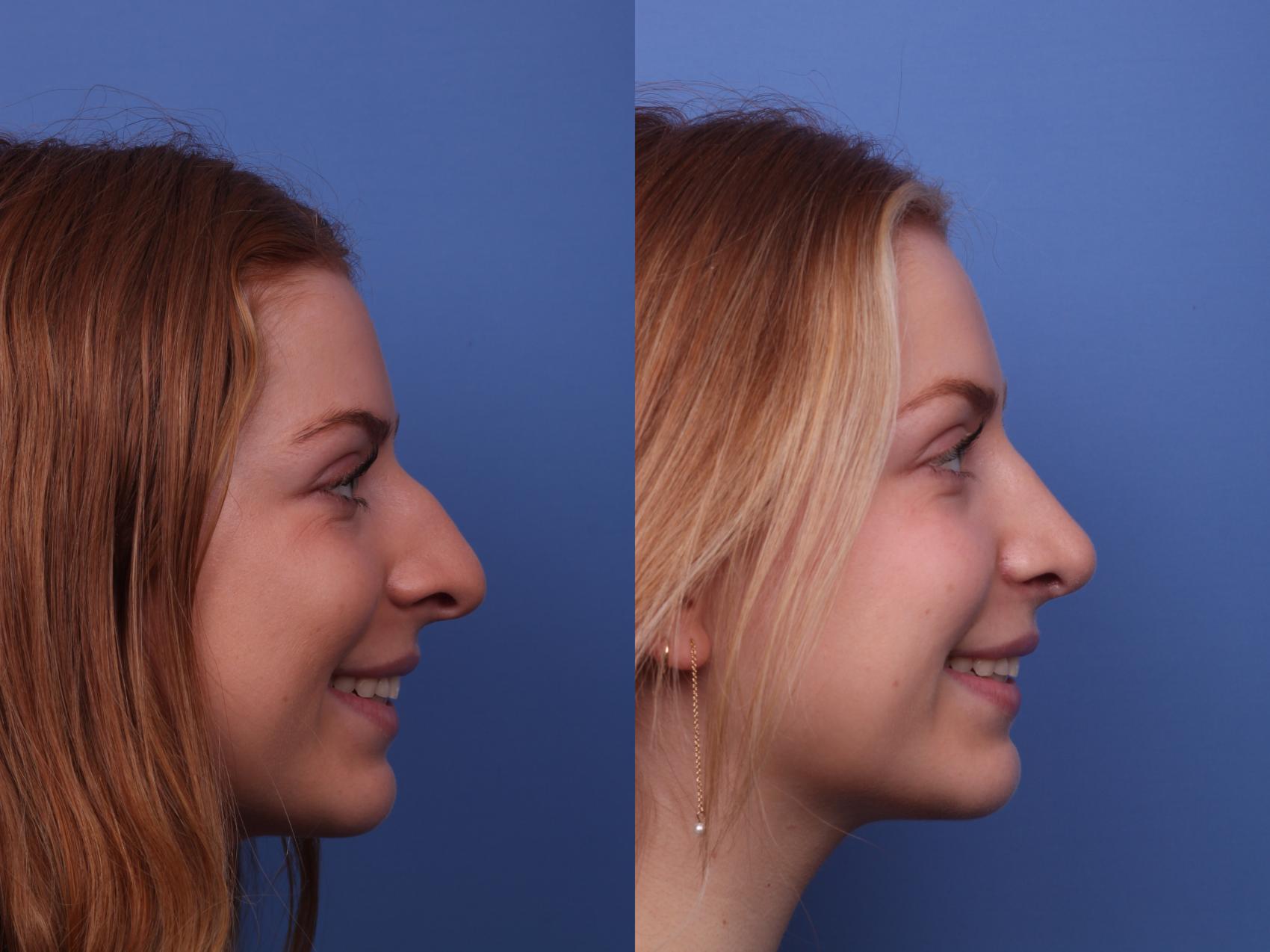 Before & After Rhinoplasty Case 380 Right Smile View in Scottsdale, AZ